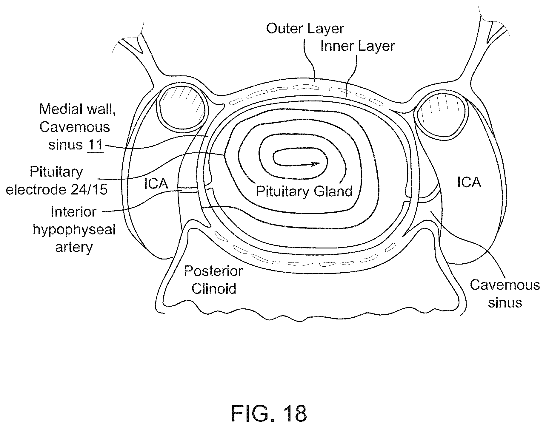 Patent US11771897 Figure 14 – System, method and catheter for pituitary and brain implantation