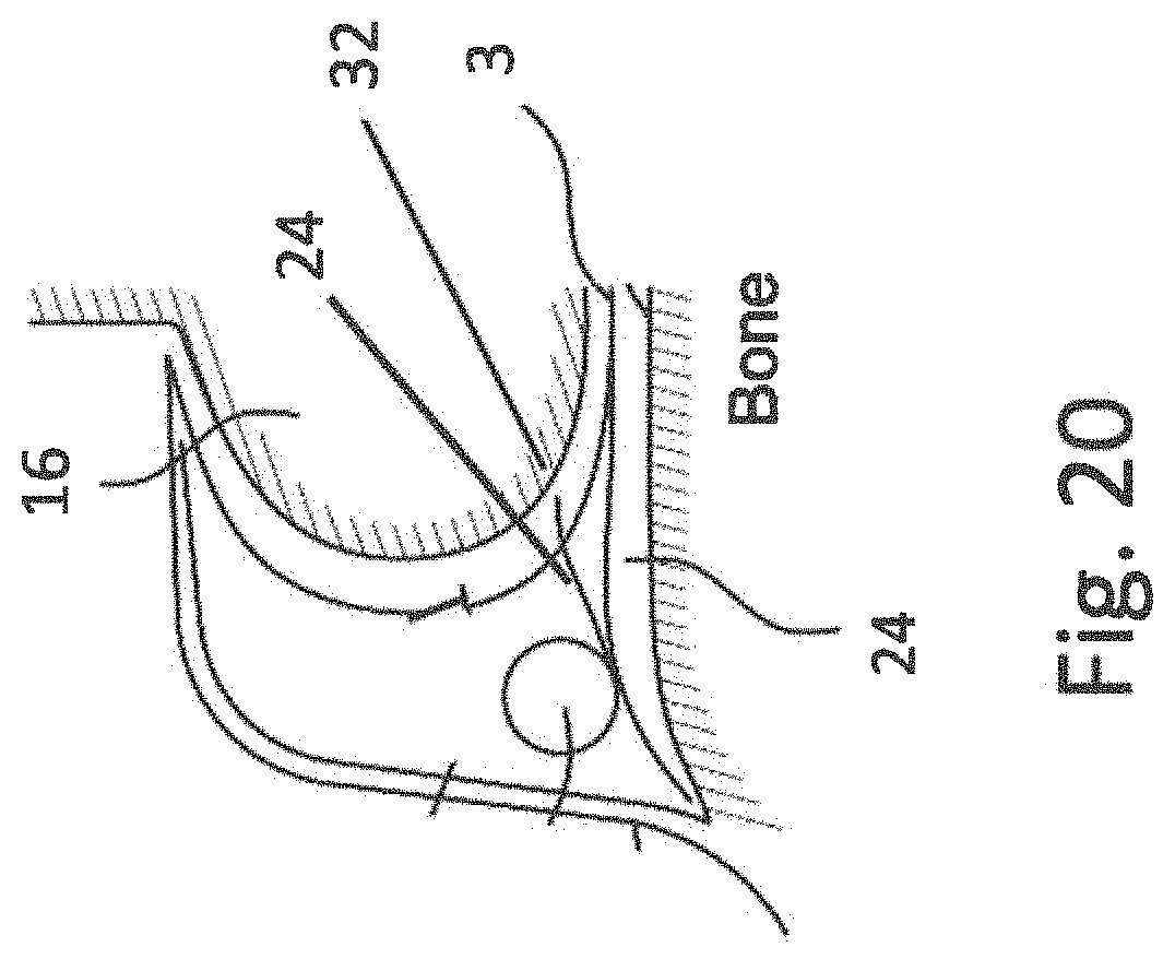Patent US11771897 Figure 16 – System, method and catheter for pituitary and brain implantation