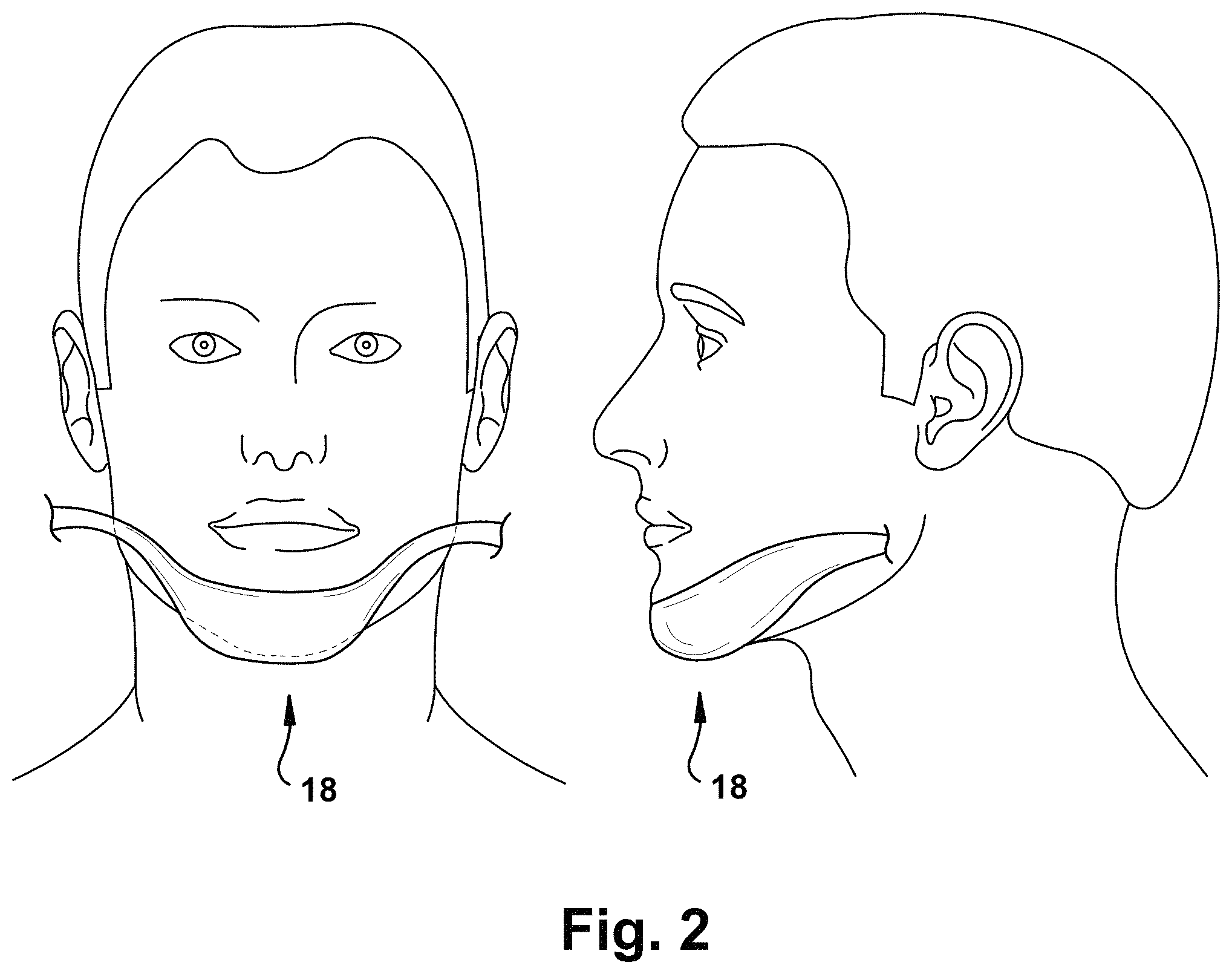 Patent US11771899 Figure 2 – System and method for treating obstructive sleep apnea