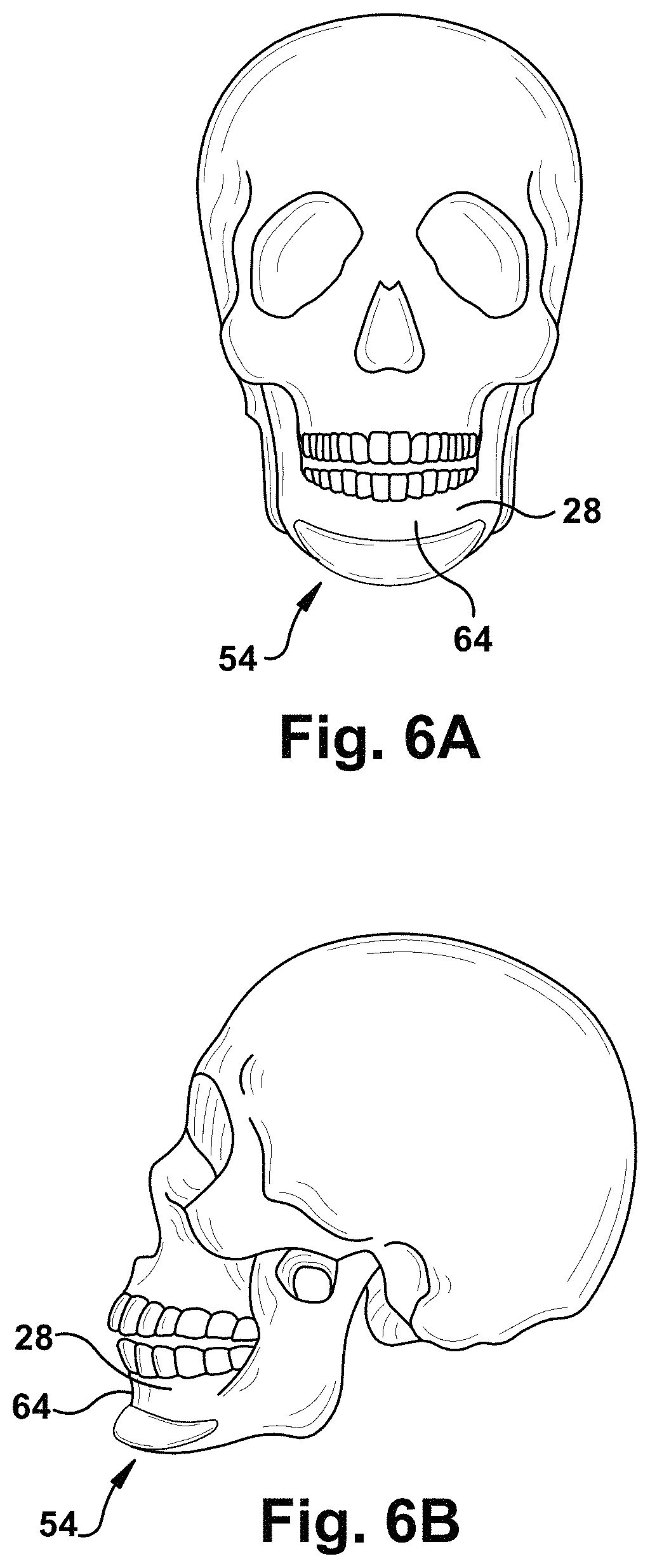 Patent US11771899 Figure 5 – System and method for treating obstructive sleep apnea