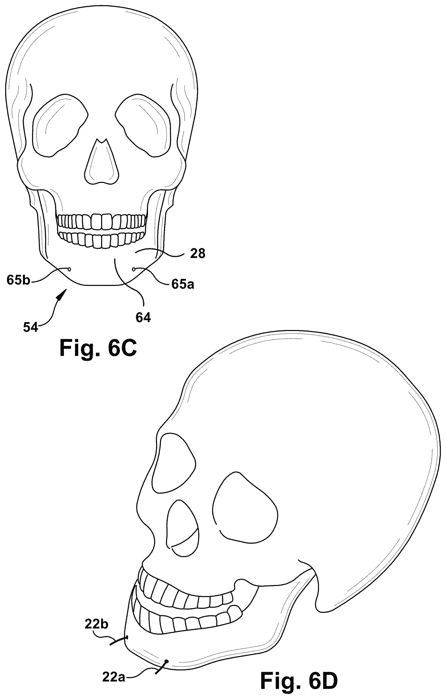 Patent US11771899 Figure 6 – System and method for treating obstructive sleep apnea