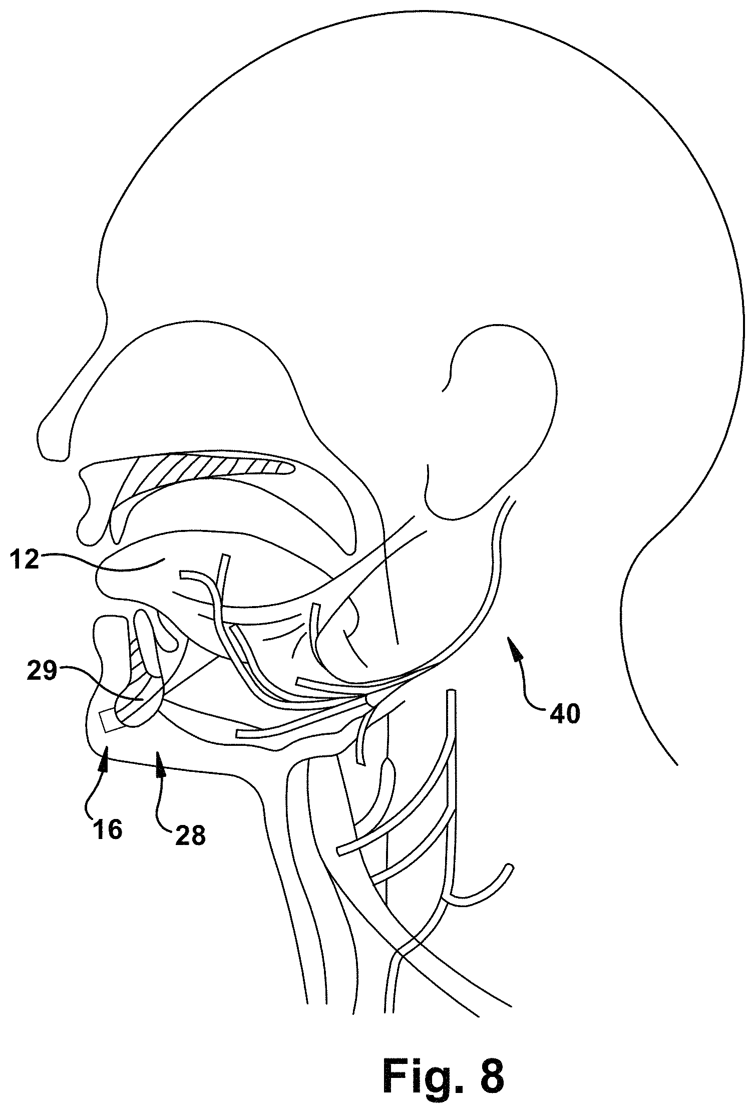 Patent US11771899 Figure 8 – System and method for treating obstructive sleep apnea