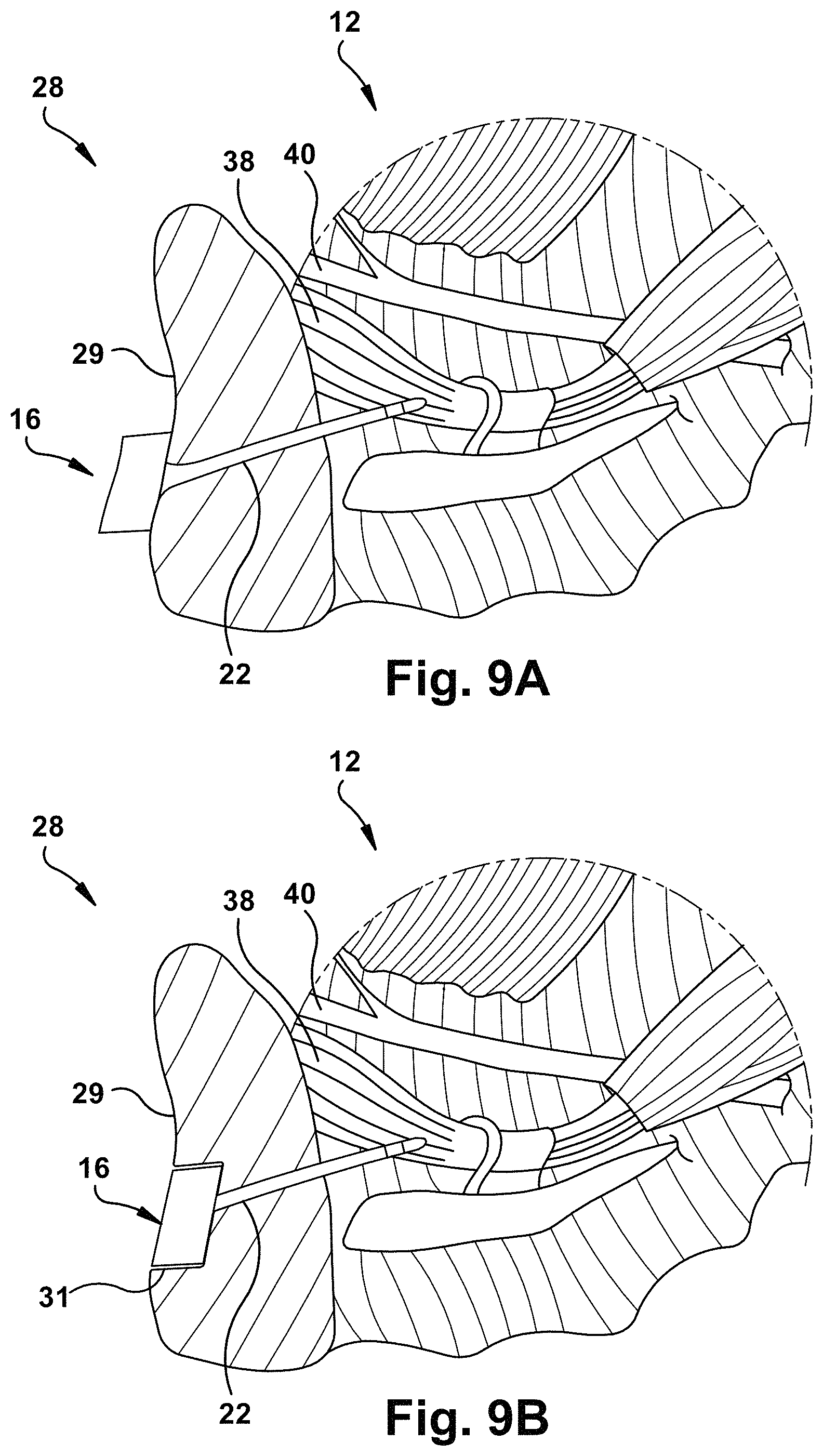 Patent US11771899 Figure 9 – System and method for treating obstructive sleep apnea