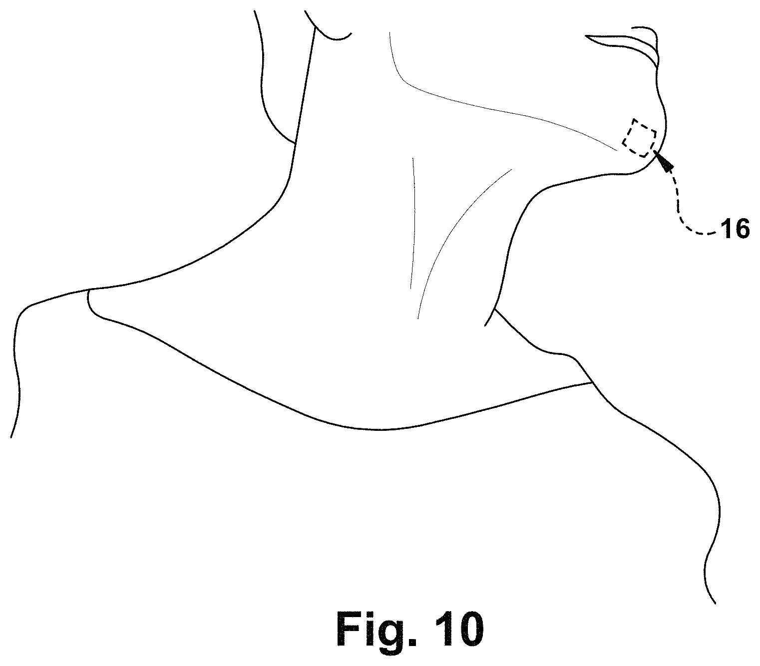 Patent US11771899 Figure 10 – System and method for treating obstructive sleep apnea