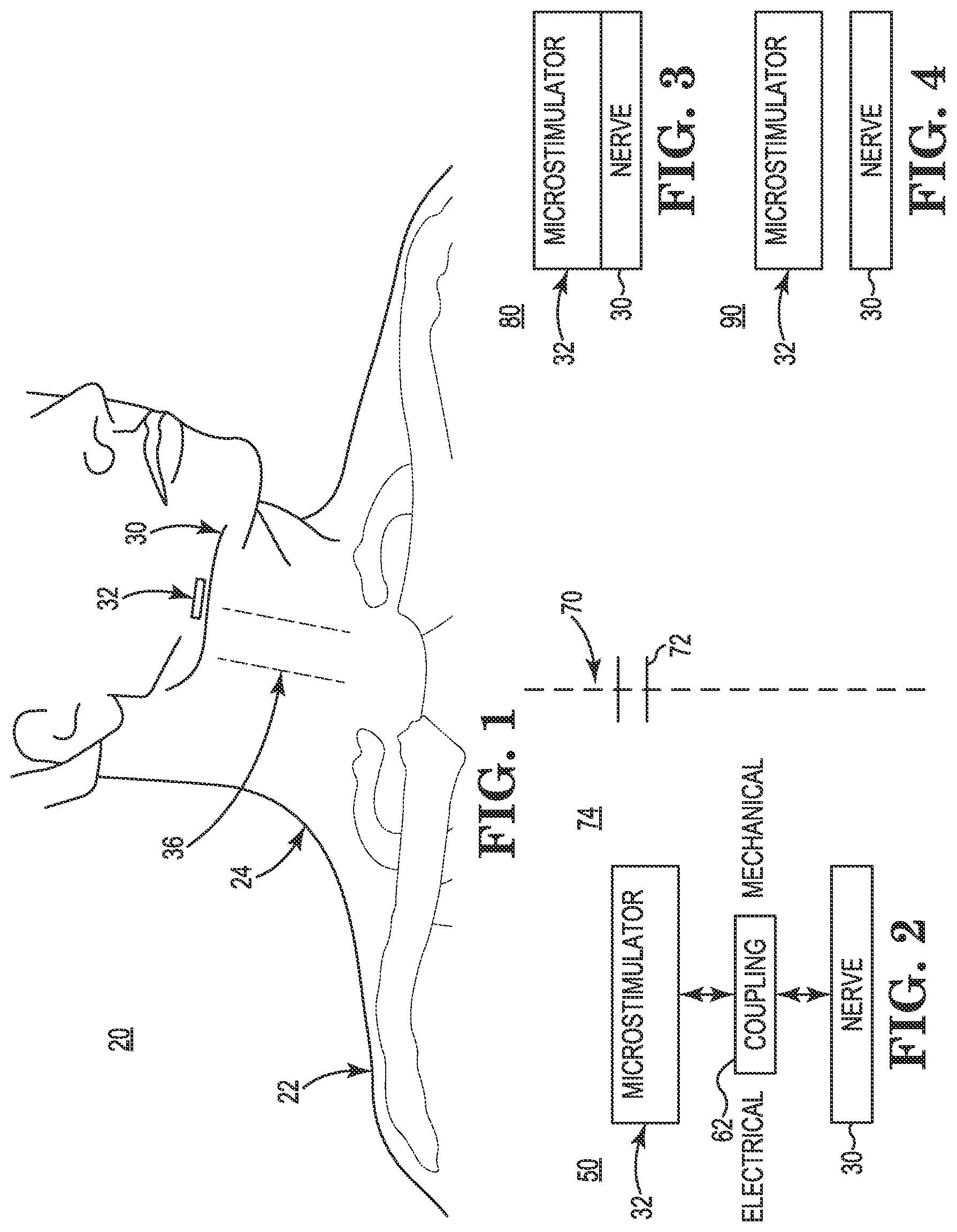 Patent US11771901 Figure 1 – Microstimulation sleep disordered breathing (SDB) therapy device