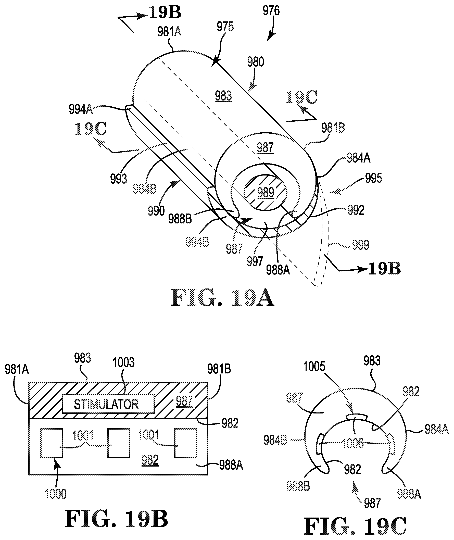 Patent US11771901 Figure 12 – Microstimulation sleep disordered breathing (SDB) therapy device