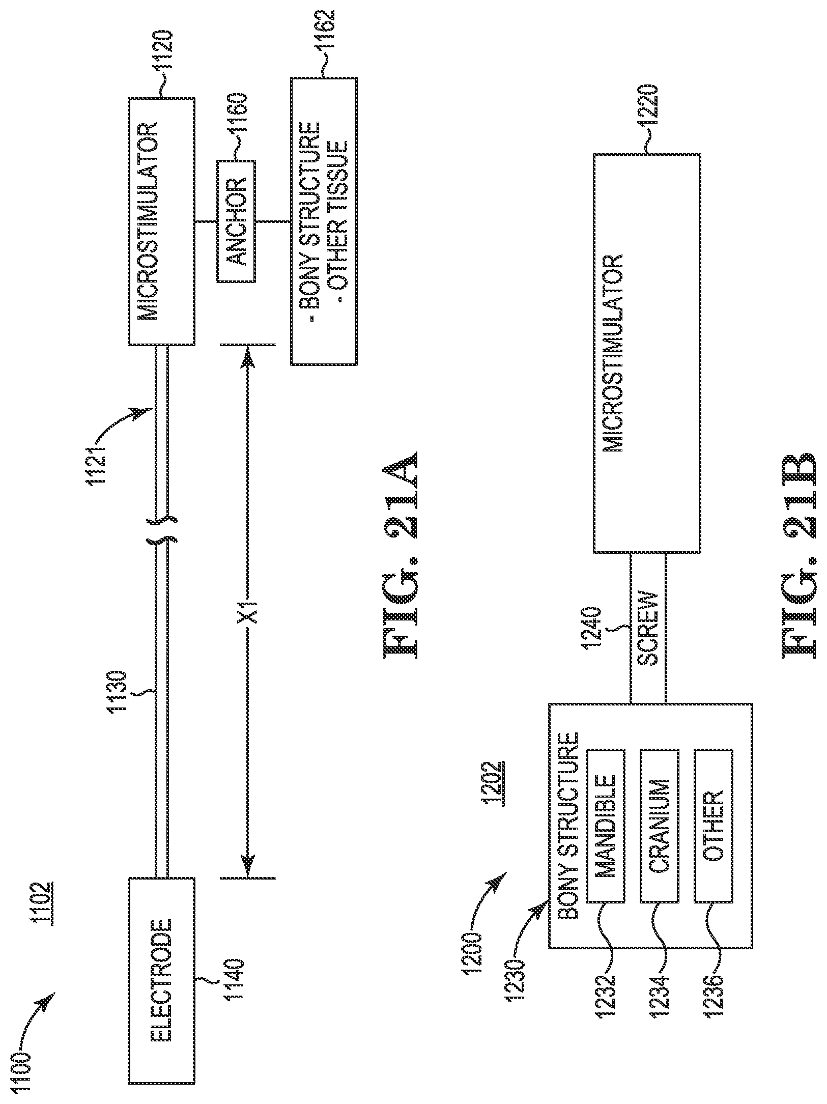 Patent US11771901 Figure 15 – Microstimulation sleep disordered breathing (SDB) therapy device