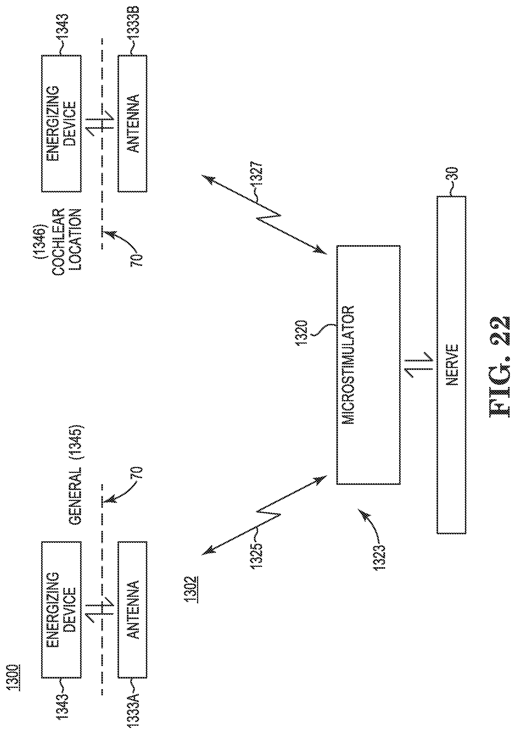 Patent US11771901 Figure 16 – Microstimulation sleep disordered breathing (SDB) therapy device