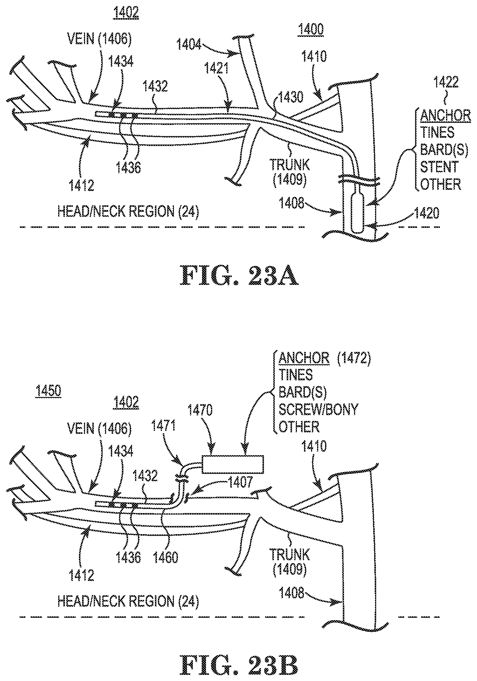 Patent US11771901 Figure 17 – Microstimulation sleep disordered breathing (SDB) therapy device