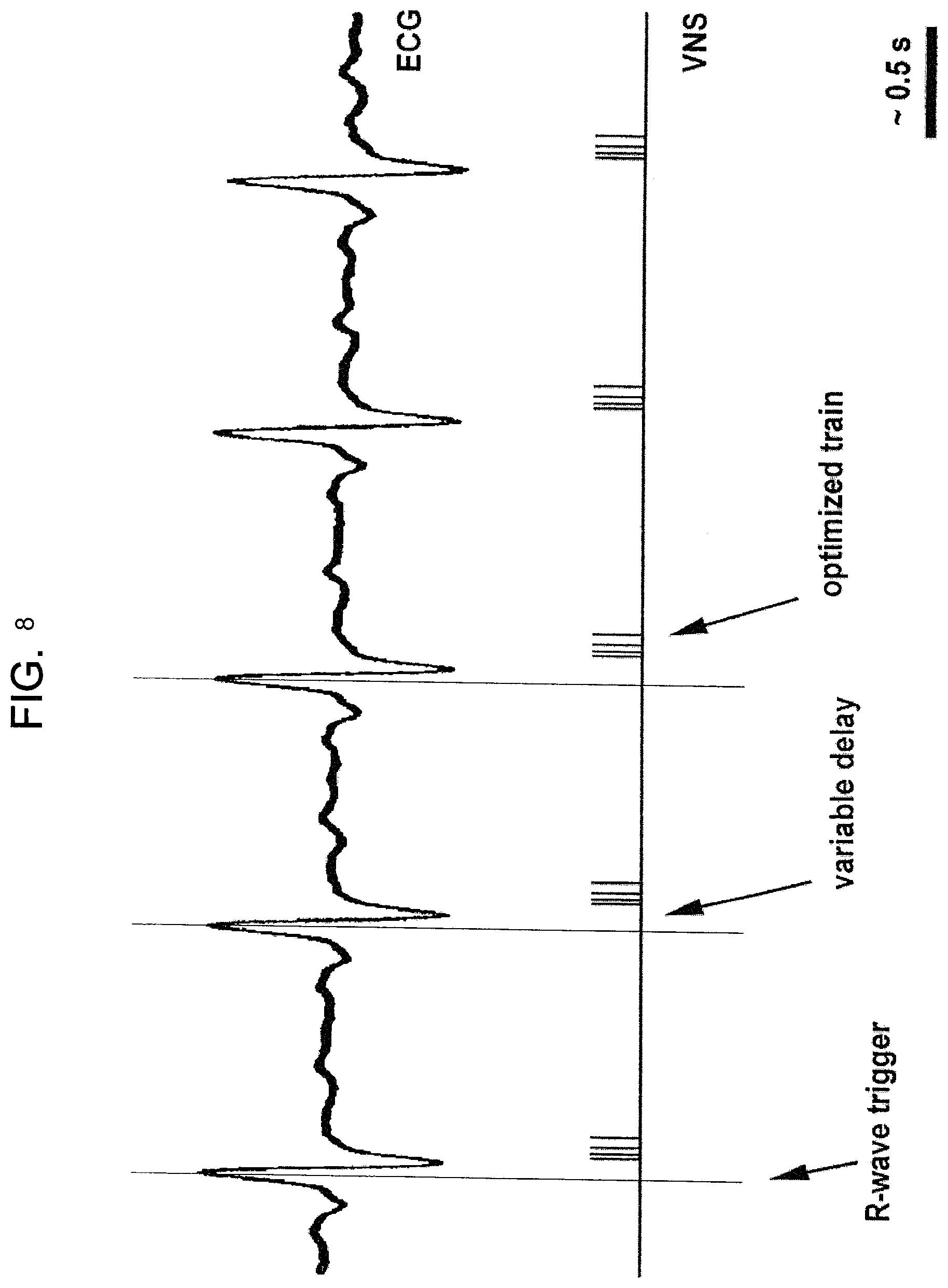 Patent US11771902 Figure 9 – Synchronization of vagus nerve stimulation with the cardiac cycle of a patient