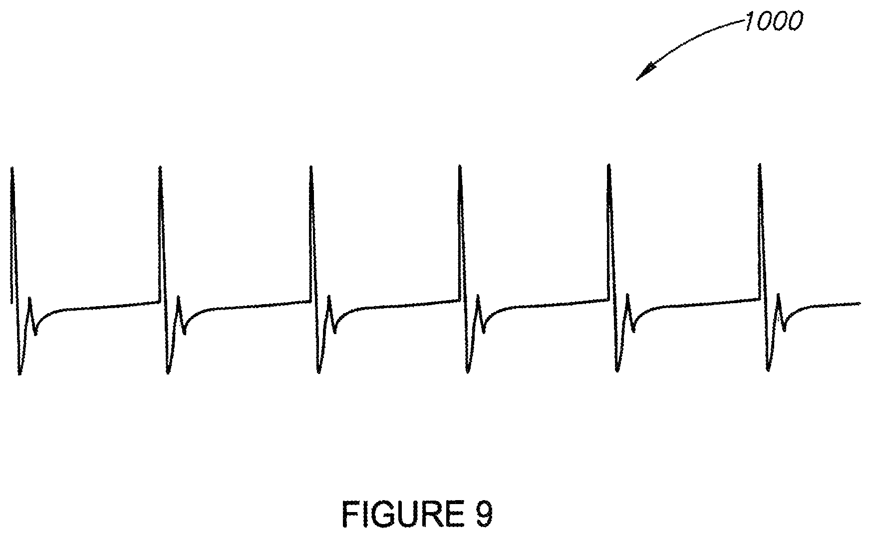 Patent US11771902 Figure 10 – Synchronization of vagus nerve stimulation with the cardiac cycle of a patient