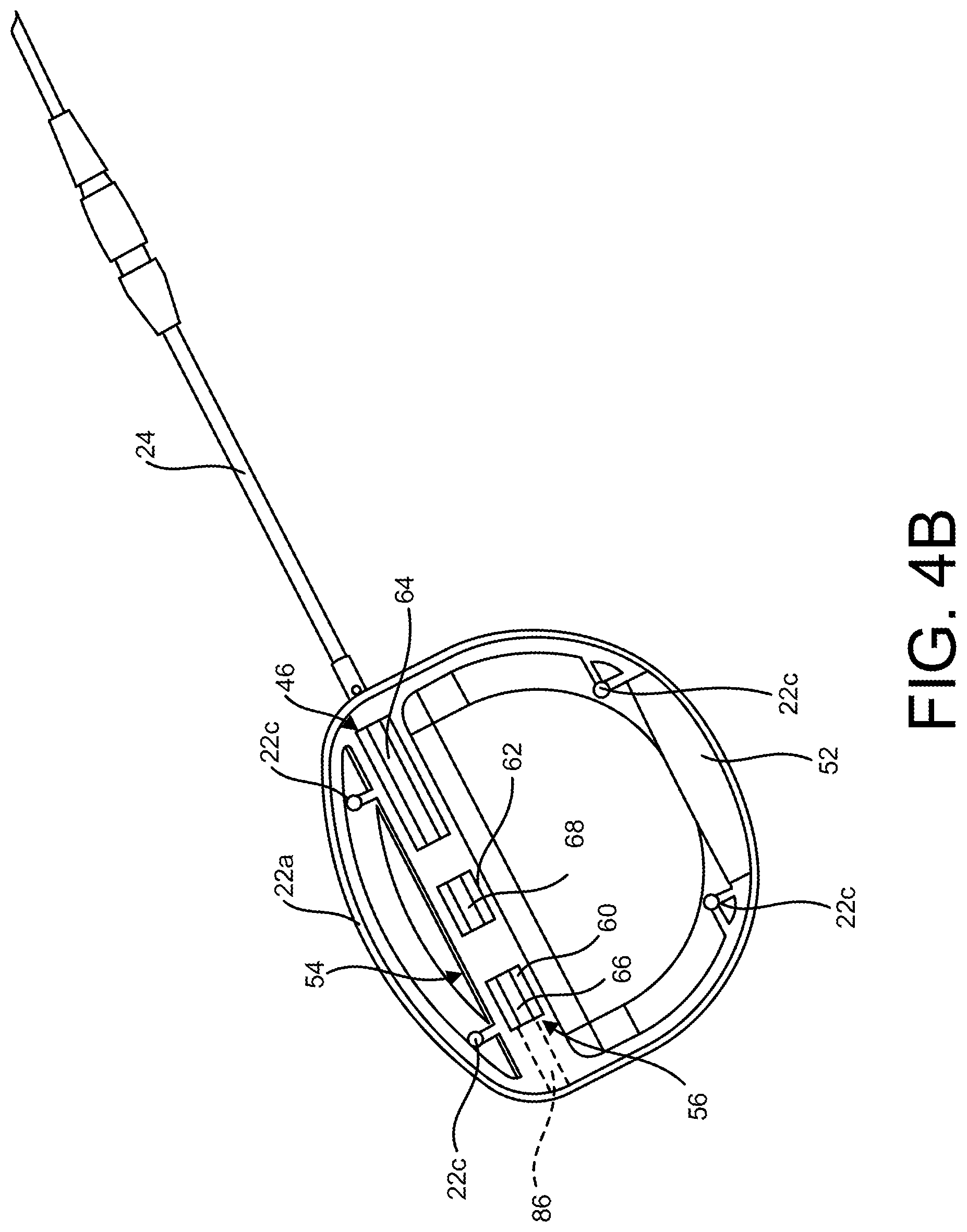 Patent US11771906 Figure 5 – Temporary pacemaker