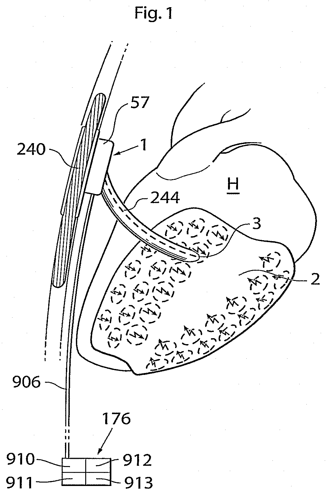 Patent US11771907 — Heart help device, system, and method — Figure 1