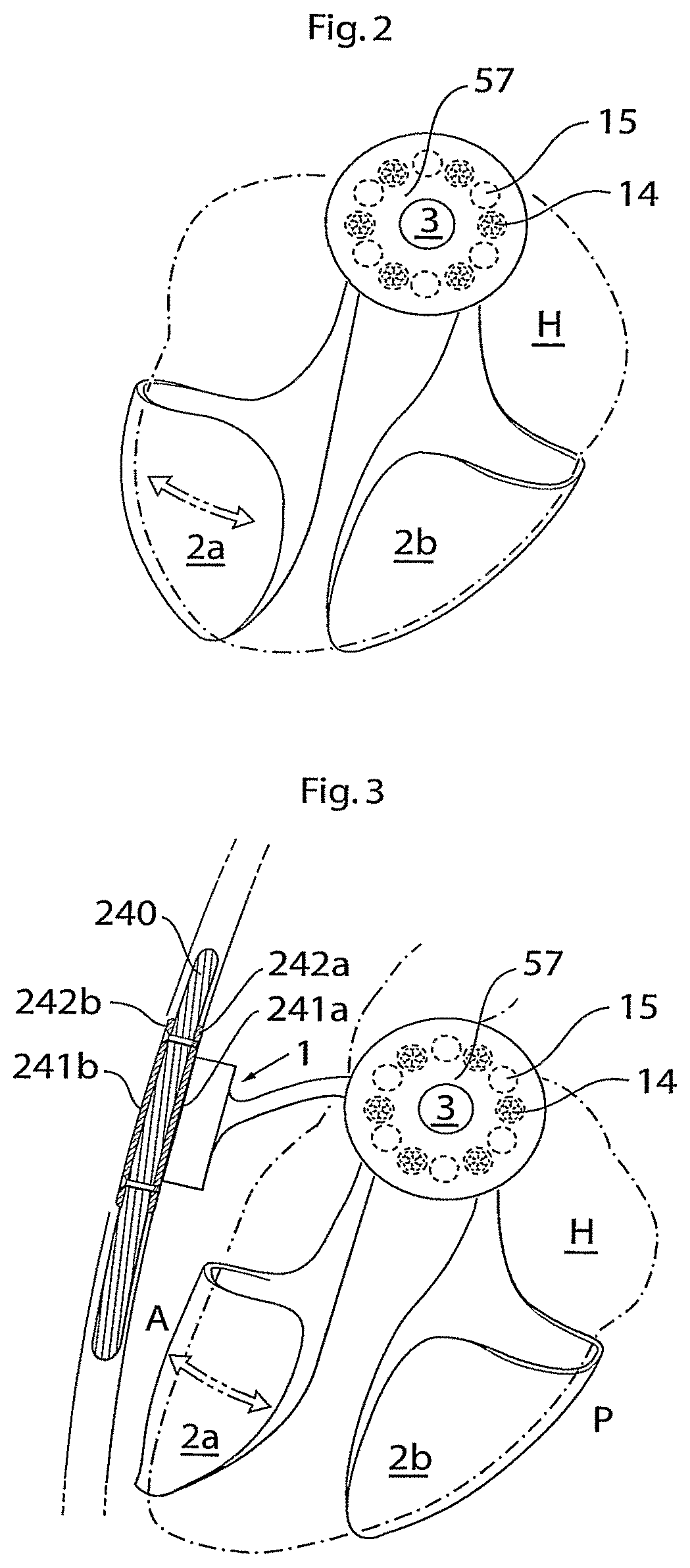 Patent US11771907 Figure 2 – Heart help device, system, and method