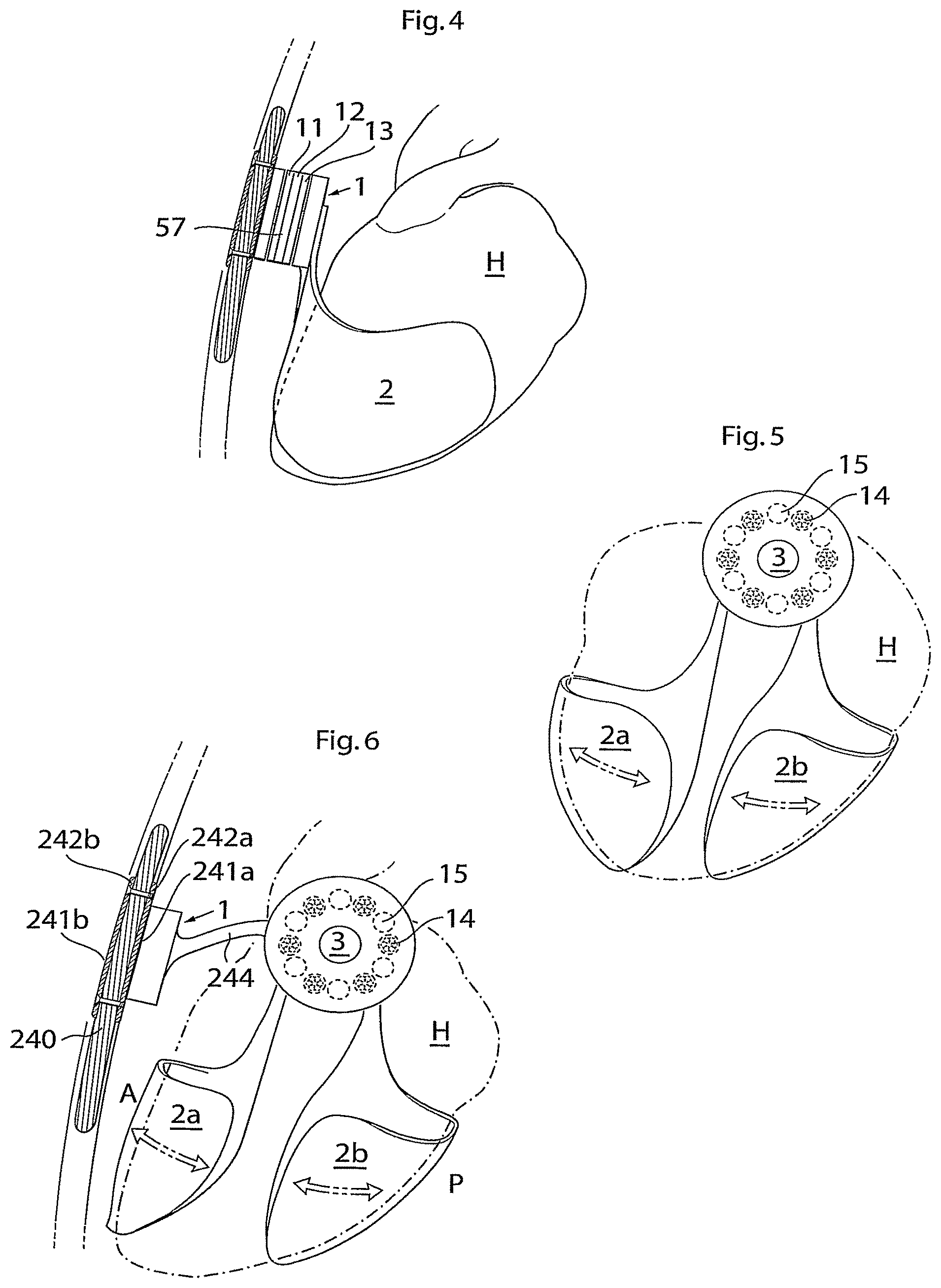 Patent US11771907 Figure 3 – Heart help device, system, and method