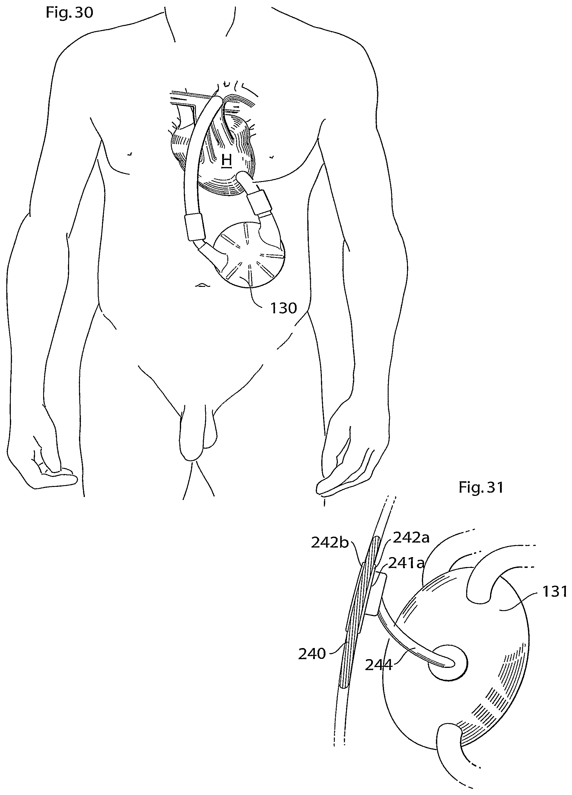 Patent US11771907 Figure 12 – Heart help device, system, and method