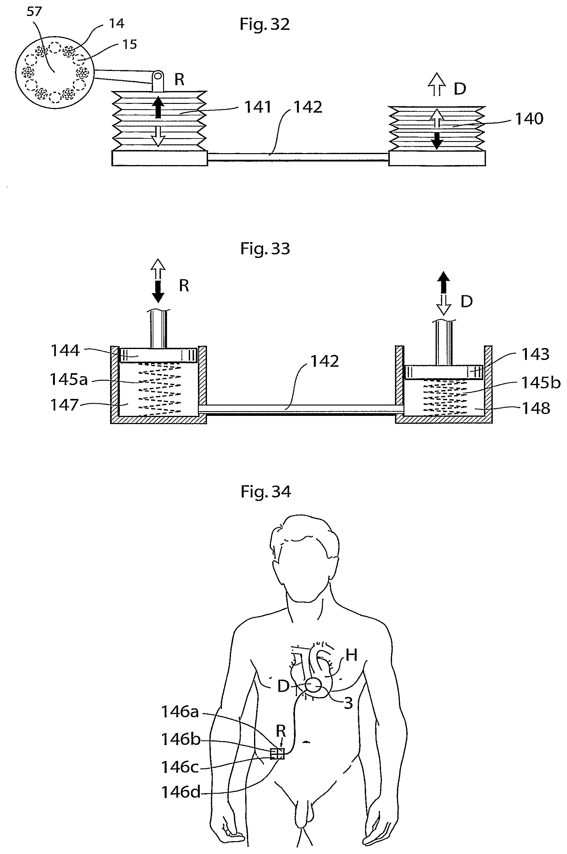 Patent US11771907 Figure 13 – Heart help device, system, and method