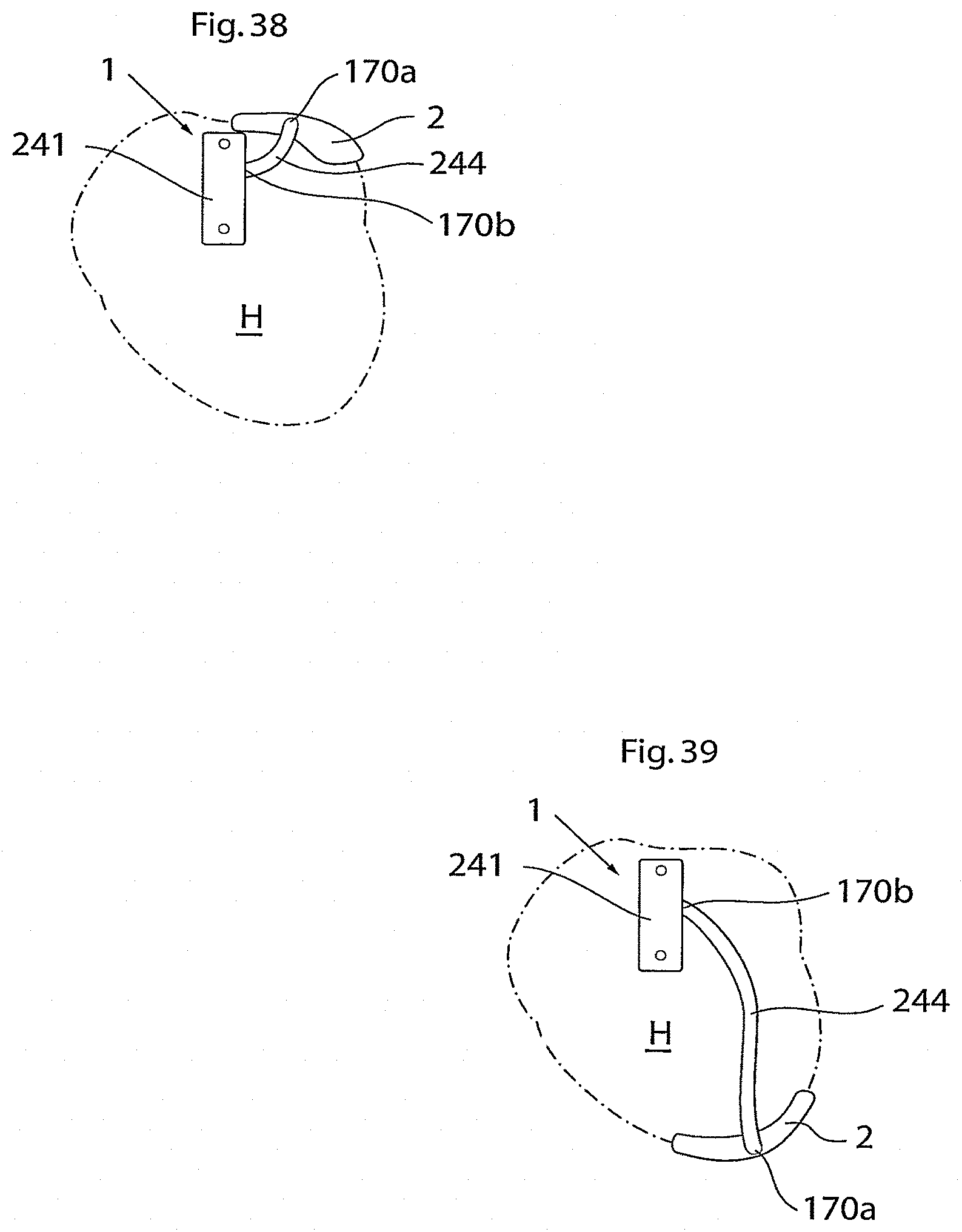 Patent US11771907 Figure 15 – Heart help device, system, and method