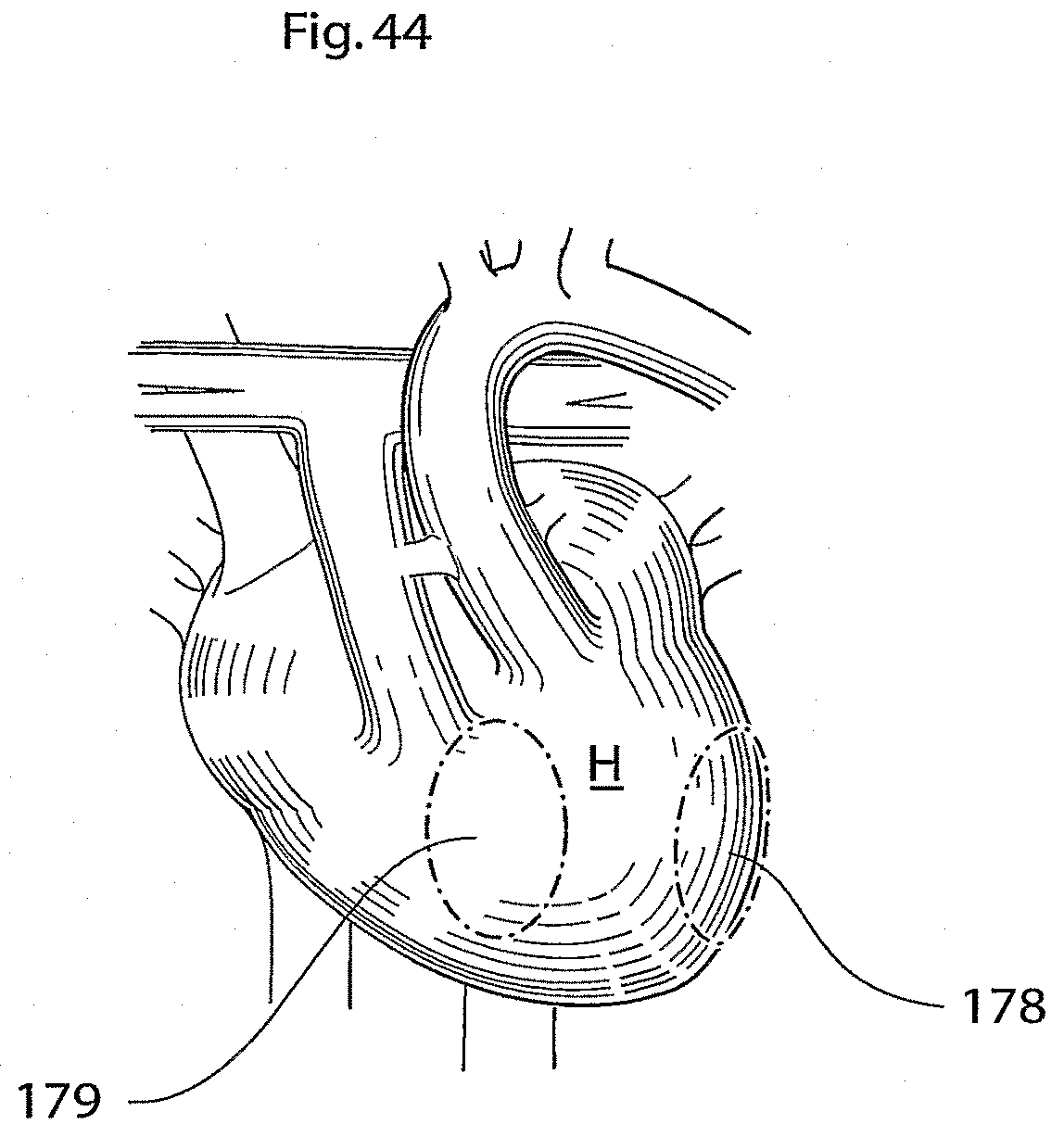 Patent US11771907 Figure 18 – Heart help device, system, and method