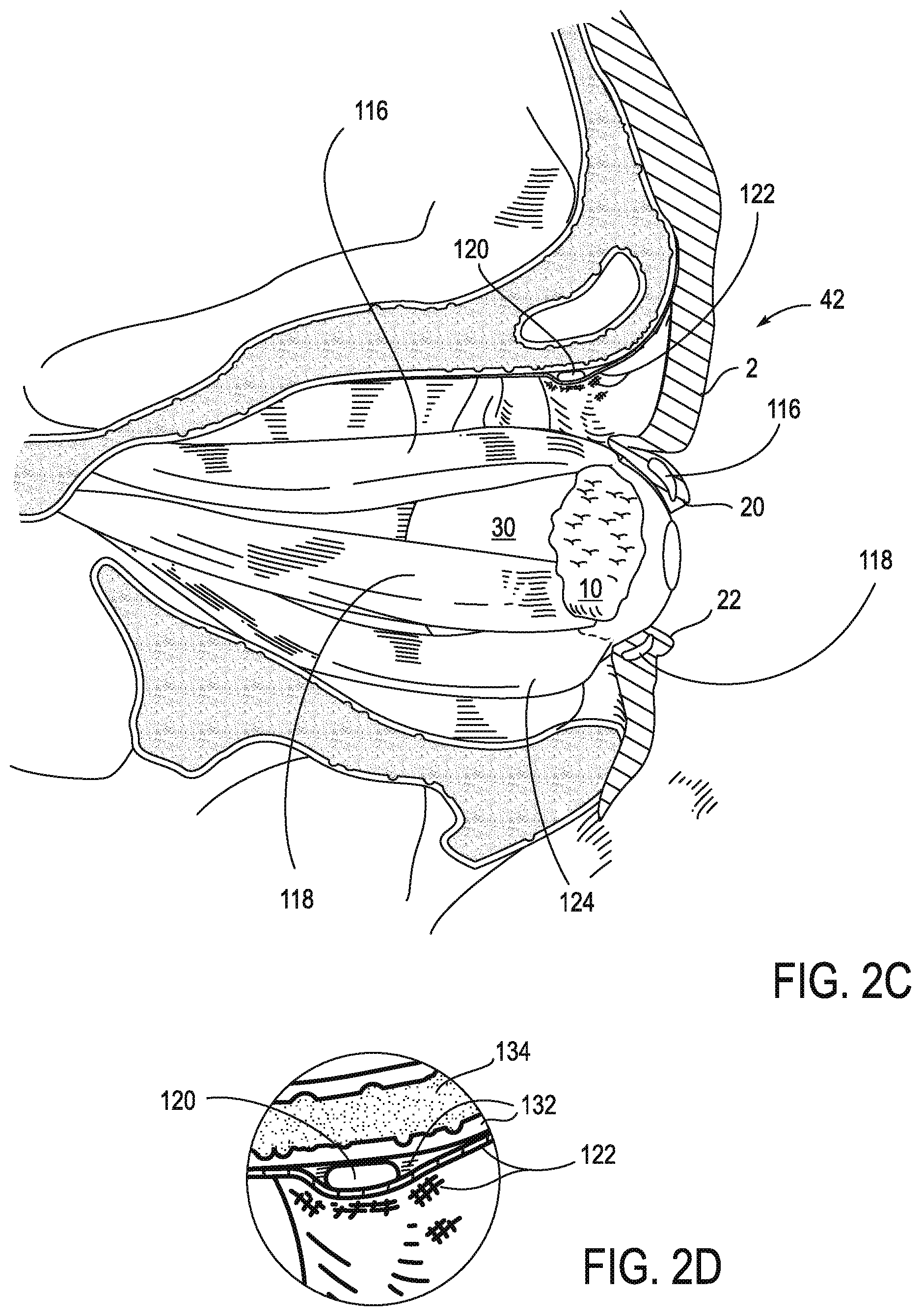 Patent US11771908 Figure 3 – Systems and methods for treatment of dry eye