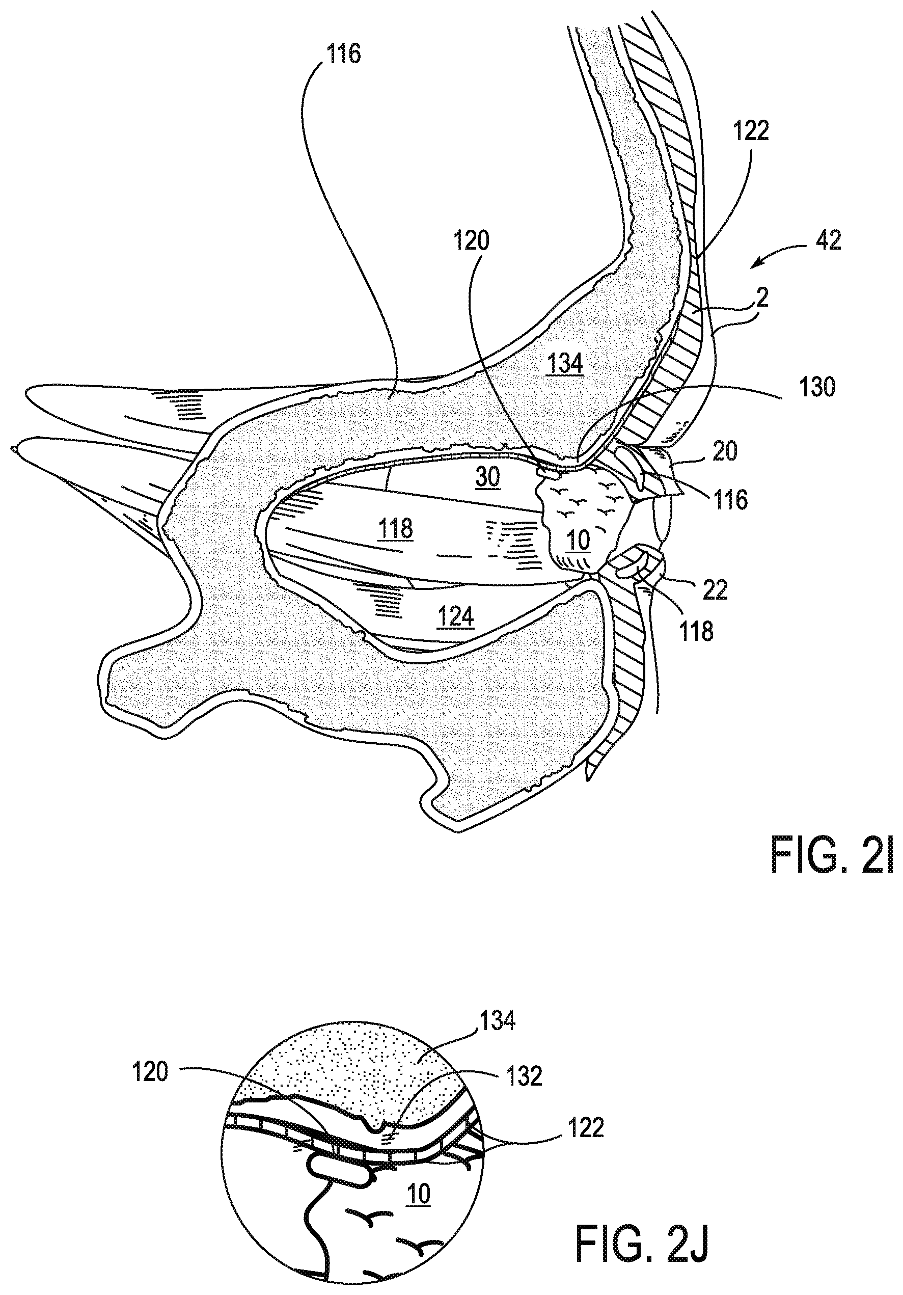 Patent US11771908 Figure 6 – Systems and methods for treatment of dry eye