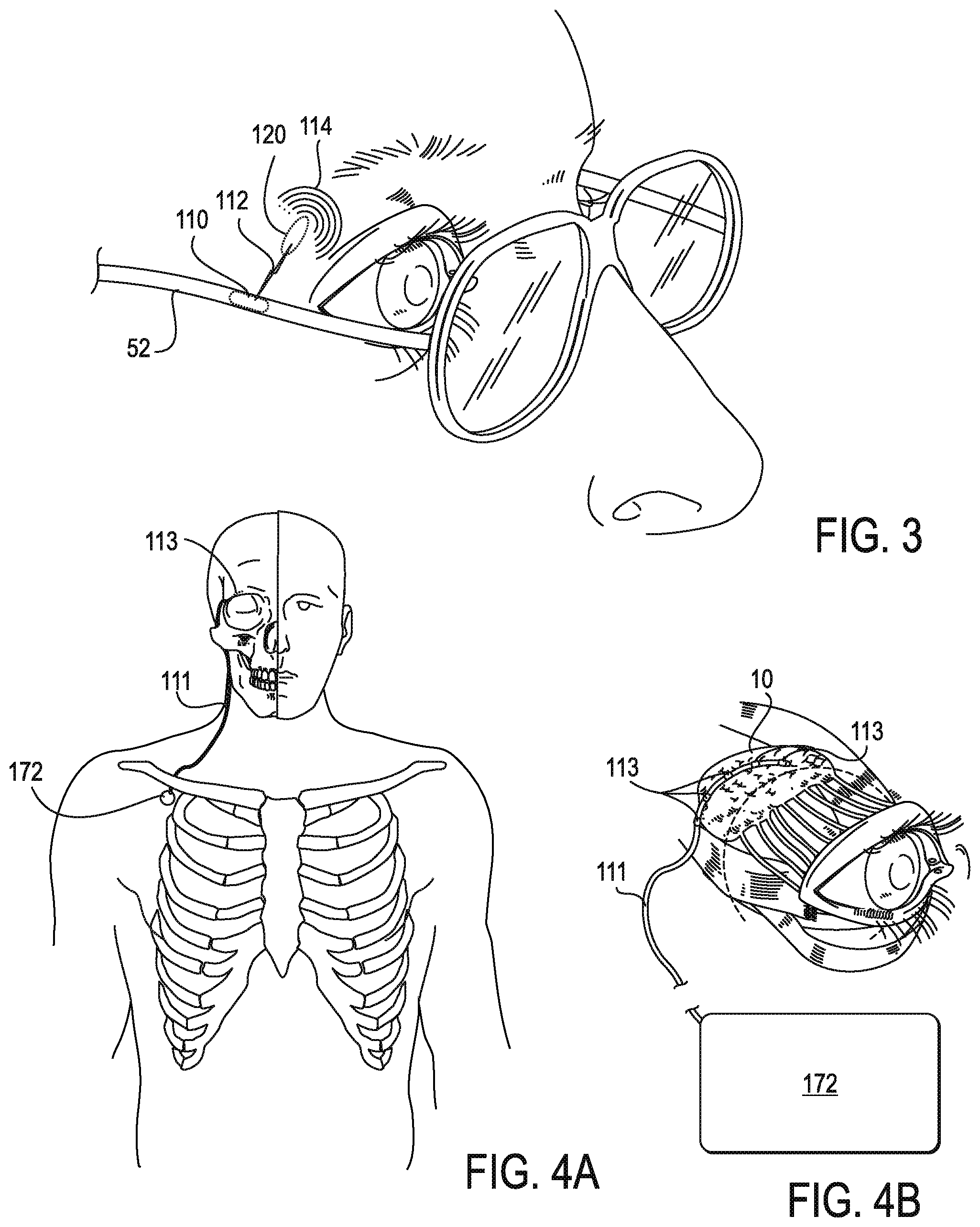 Patent US11771908 Figure 7 – Systems and methods for treatment of dry eye
