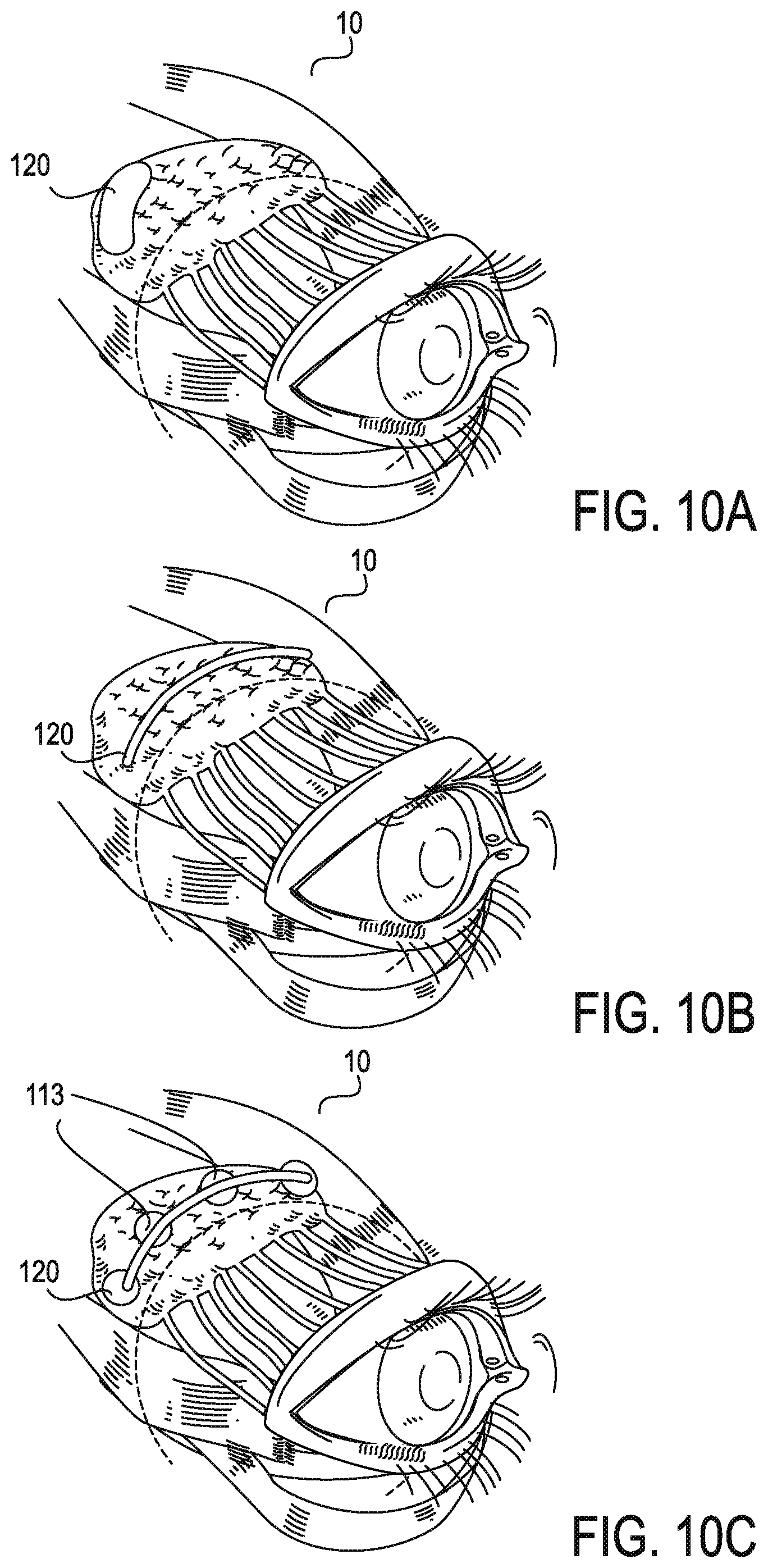 Patent US11771908 Figure 13 – Systems and methods for treatment of dry eye
