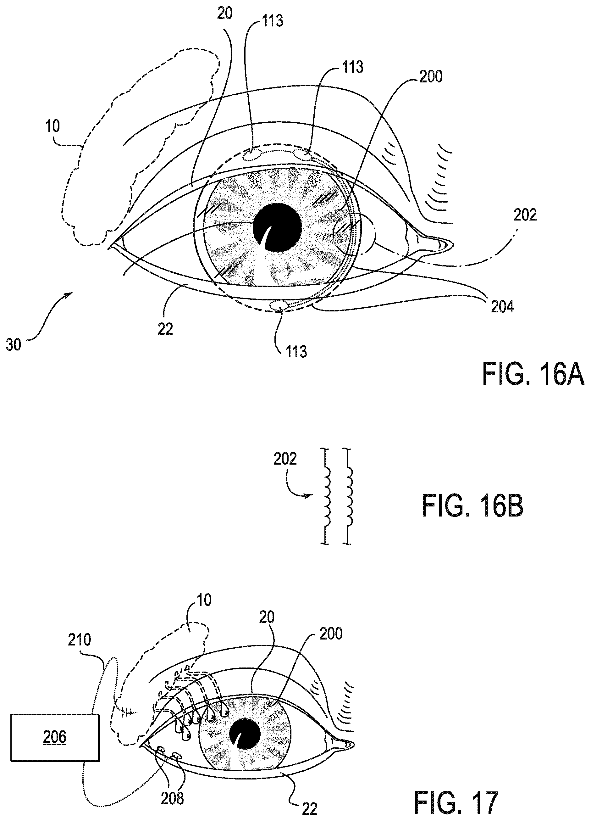 Patent US11771908 Figure 17 – Systems and methods for treatment of dry eye