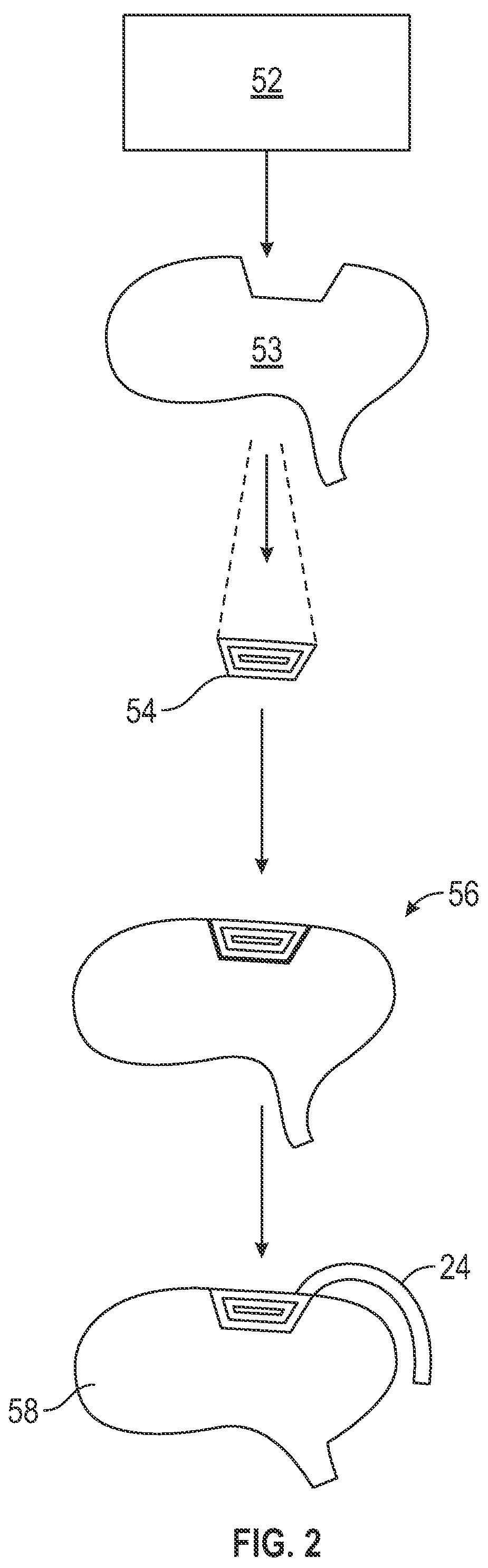 Patent US11771919 Figure 2 – Hyperthermia brachytherapy device and method for treating tumors