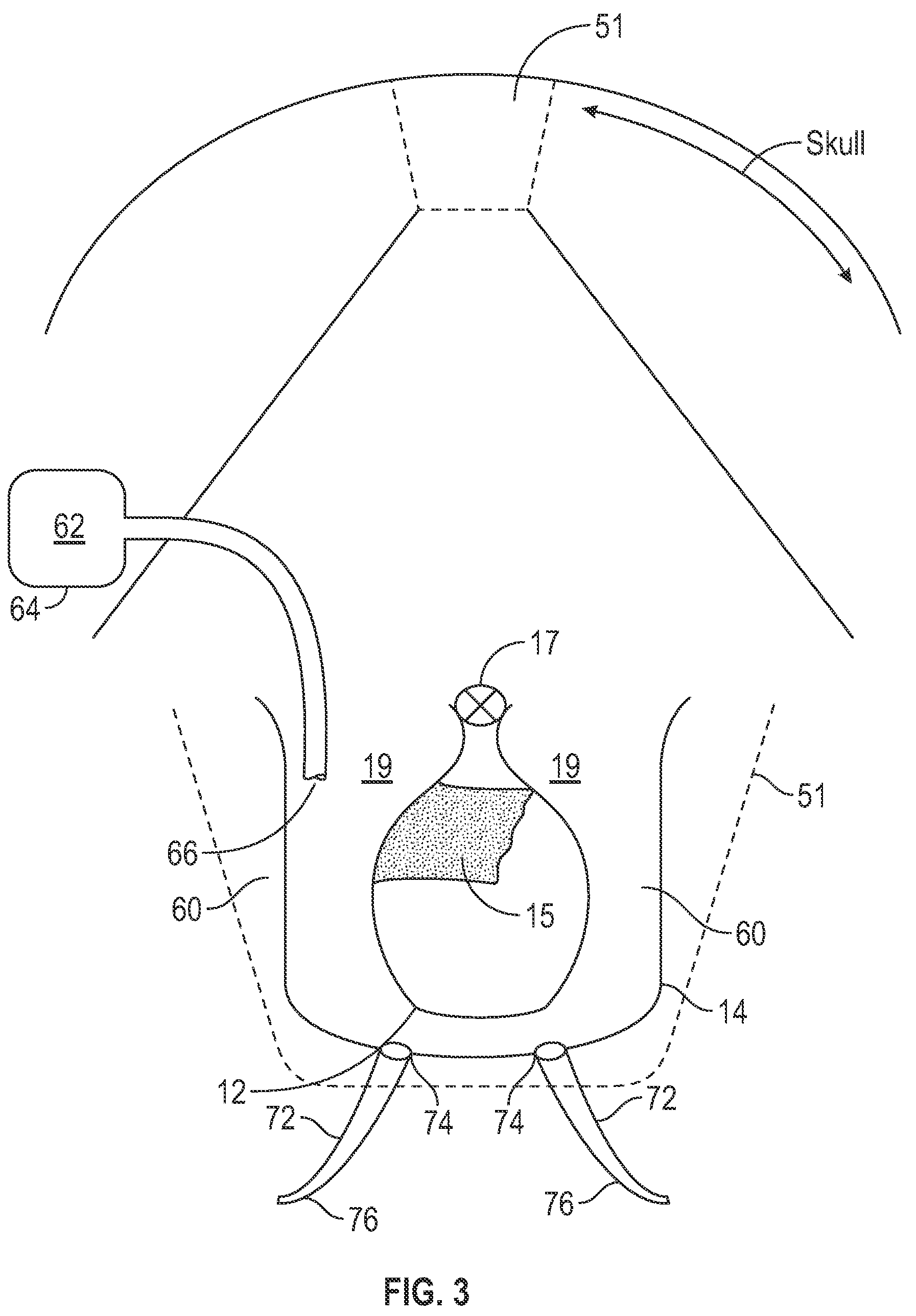 Patent US11771919 Figure 3 – Hyperthermia brachytherapy device and method for treating tumors