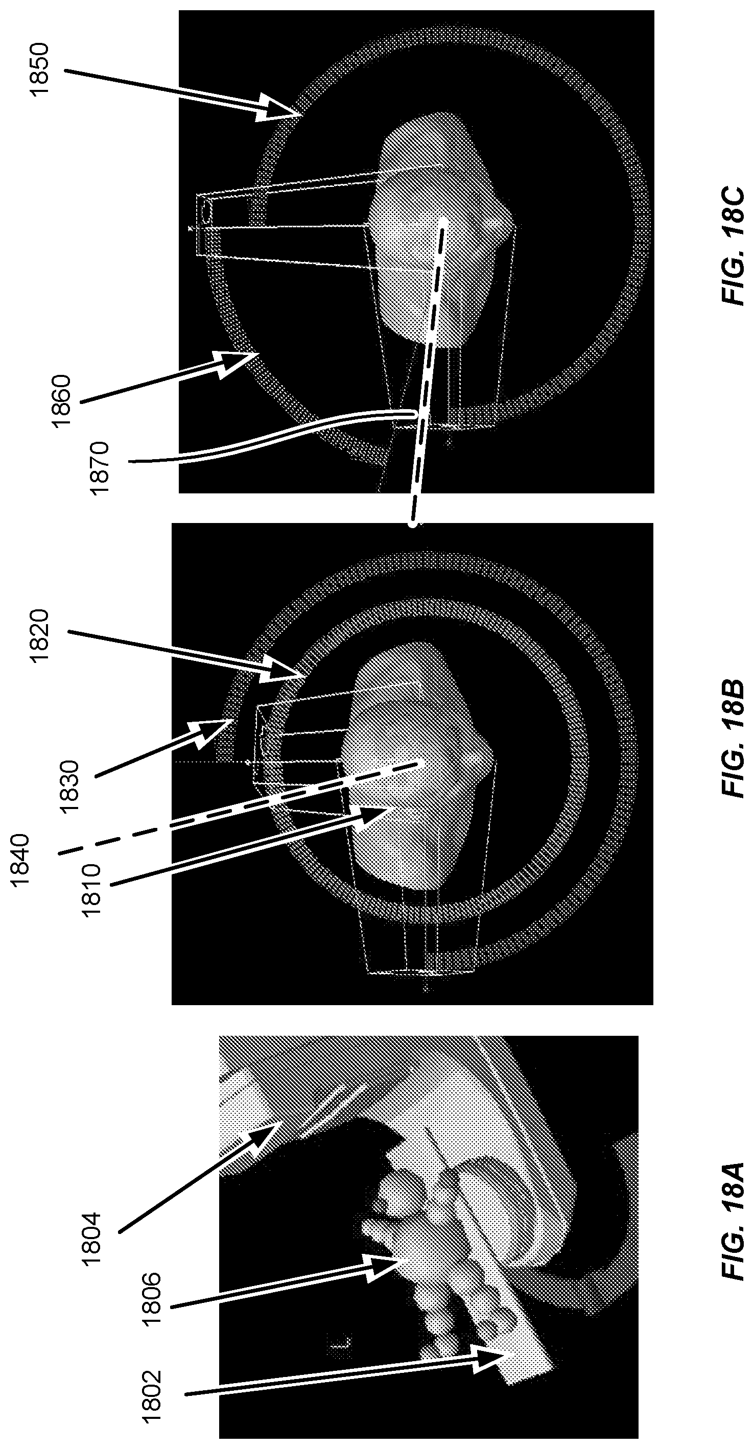 Patent US11771921 Figure 18 – Hybrid trajectory and beam angle optimization for external beam radiation therapy