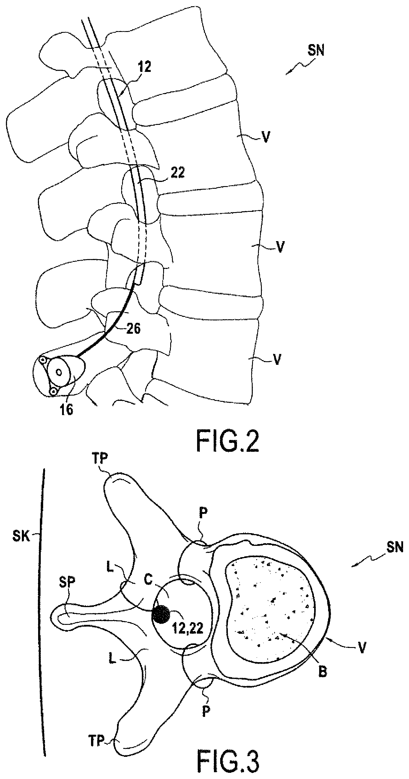 Patent US11771925 Figure 2 – Implantable ultrasound generating treating device for spinal cord and/or spinal nerve treatment, apparatus comprising such device and method