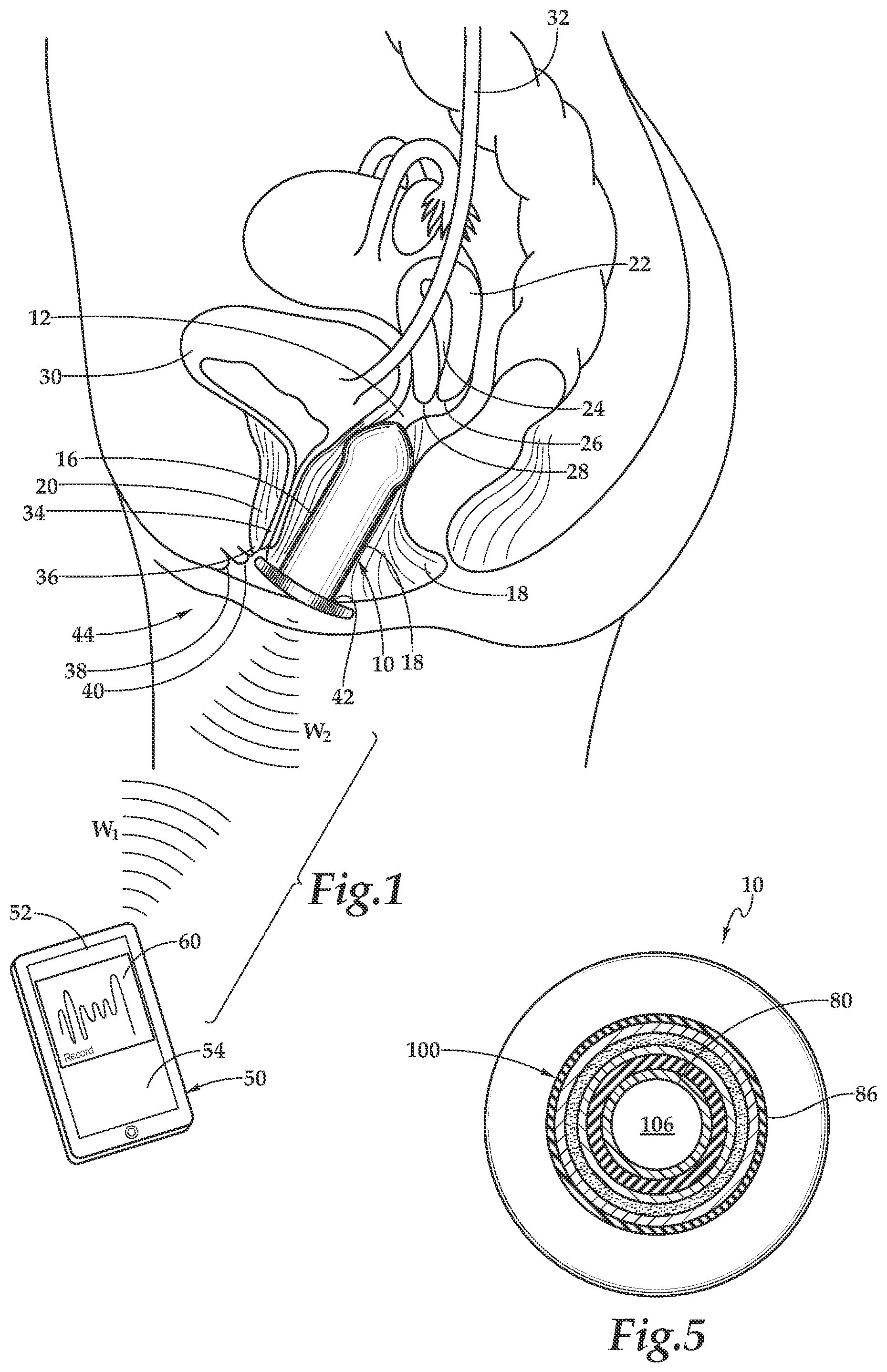 Patent US11771953 — Perineometer and method for use of same — Figure 1