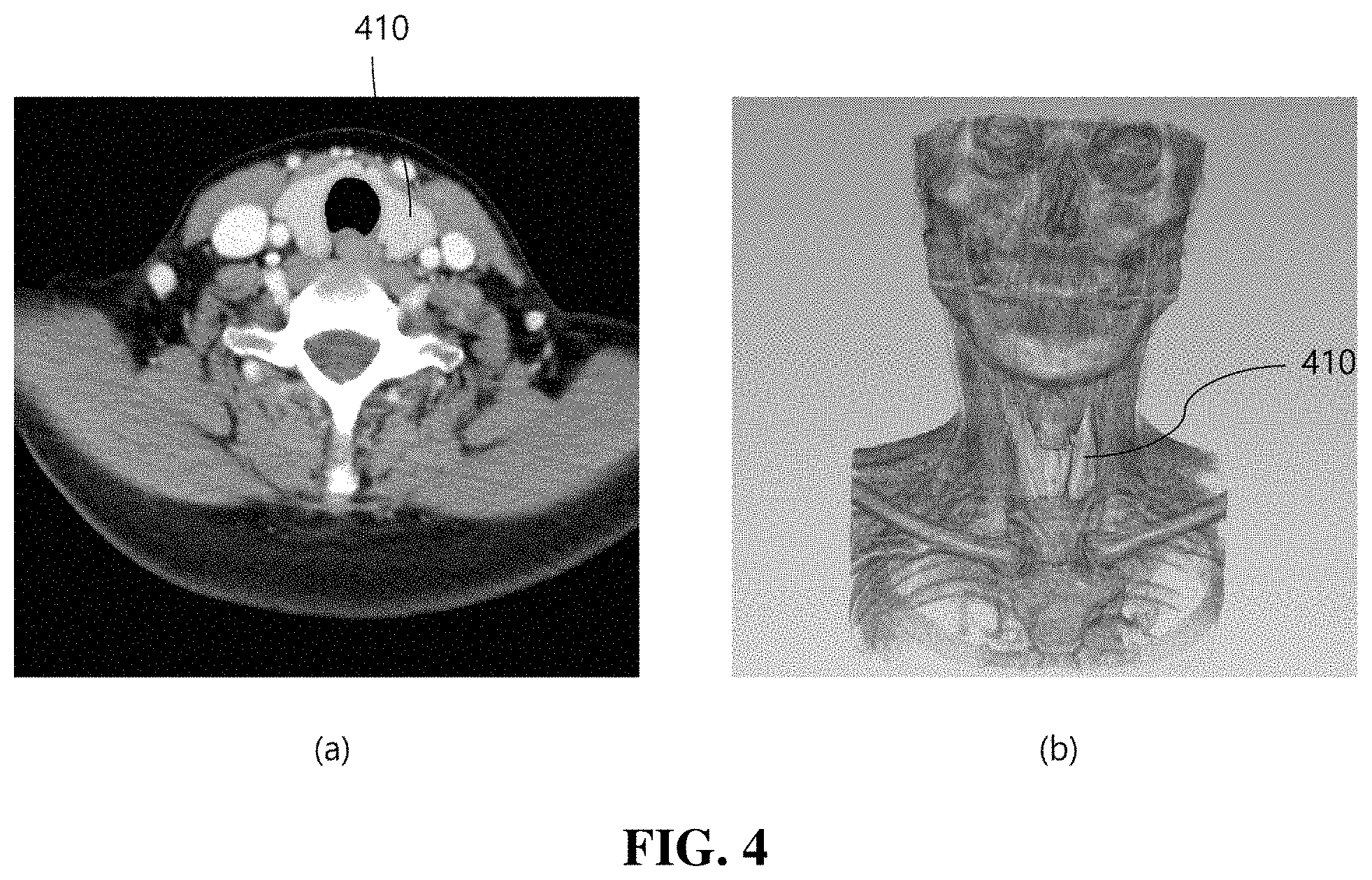 Patent US11776121 Figure 4 – Method and apparatus for providing information needed for diagnosis of lymph node metastasis of thyroid cancer