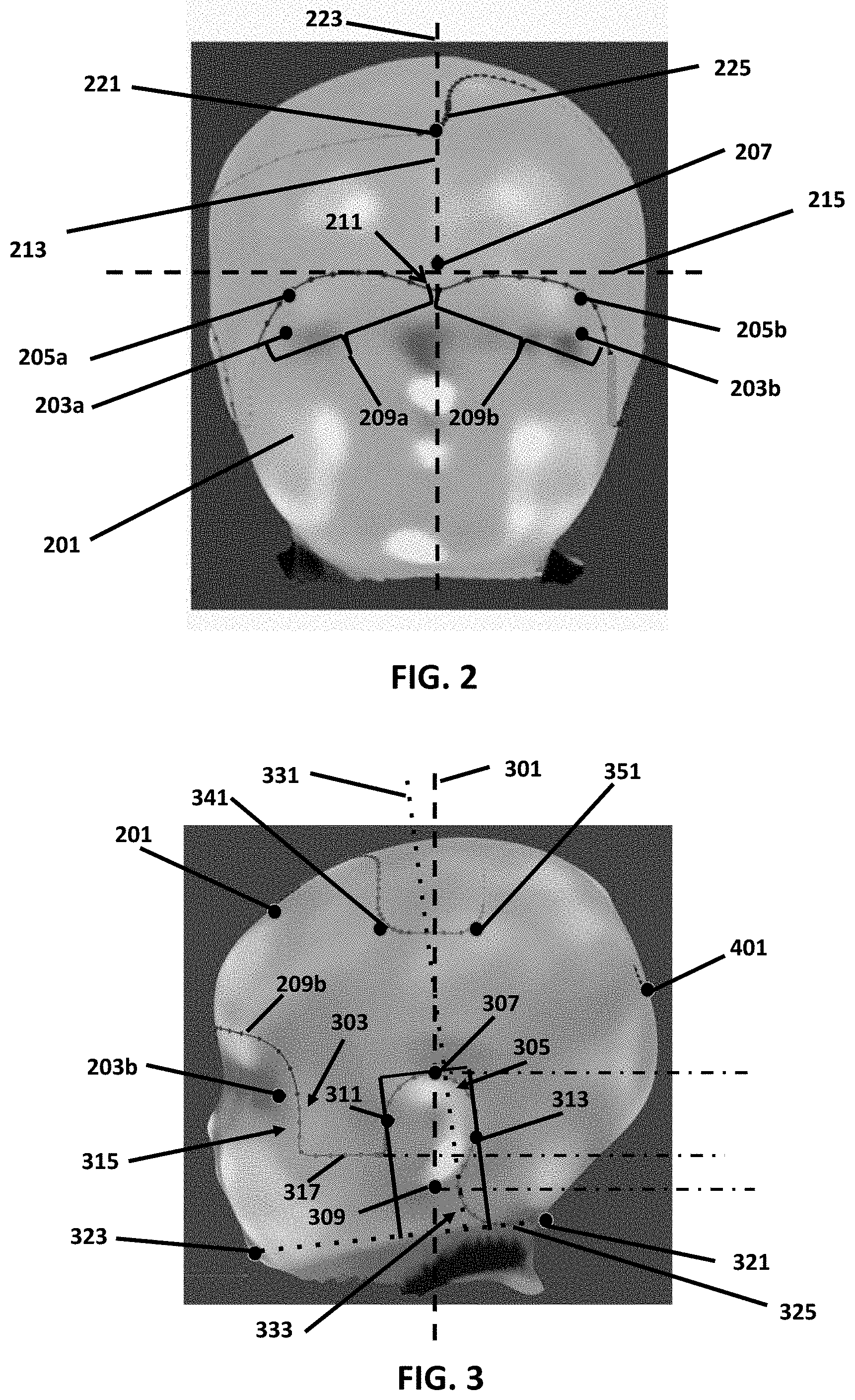 Patent US11776228 Figure 2 – Point of service manufacturing method for custom cranial remodeling device