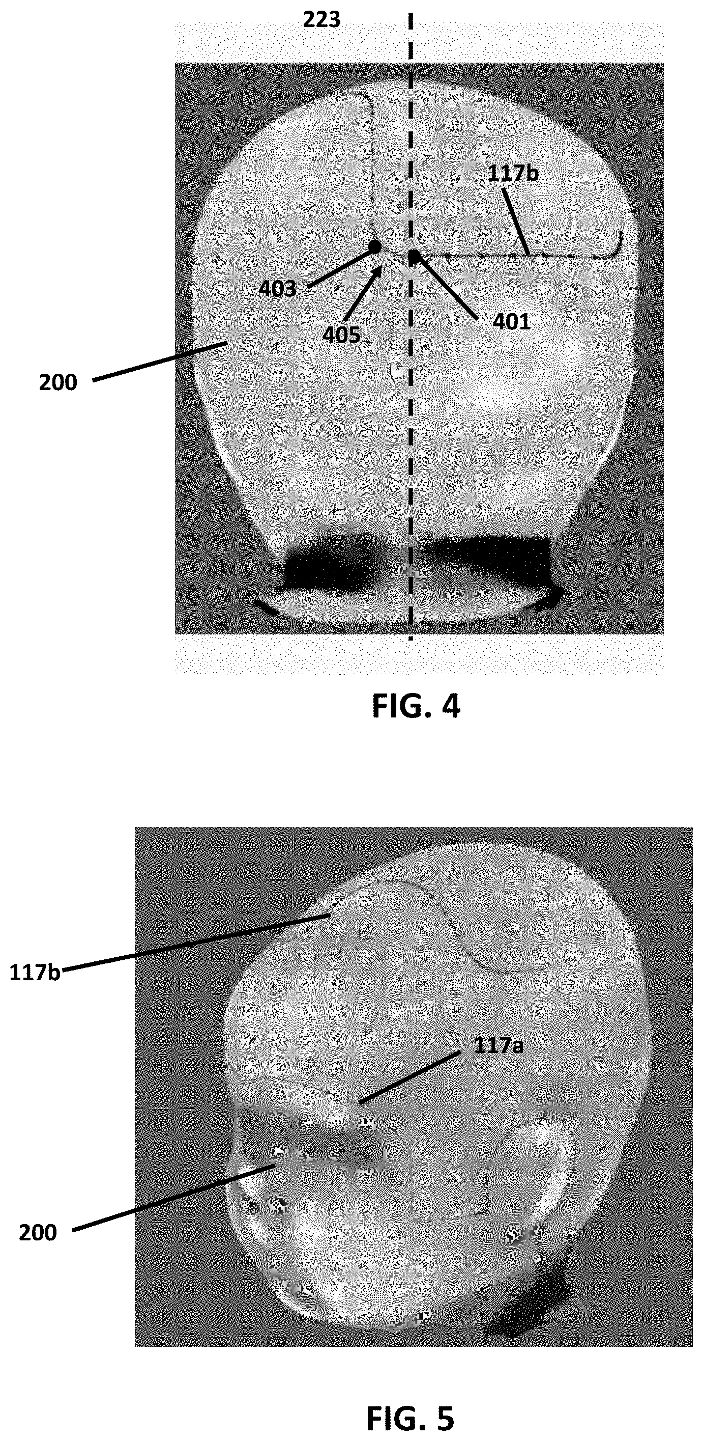 Patent US11776228 Figure 3 – Point of service manufacturing method for custom cranial remodeling device