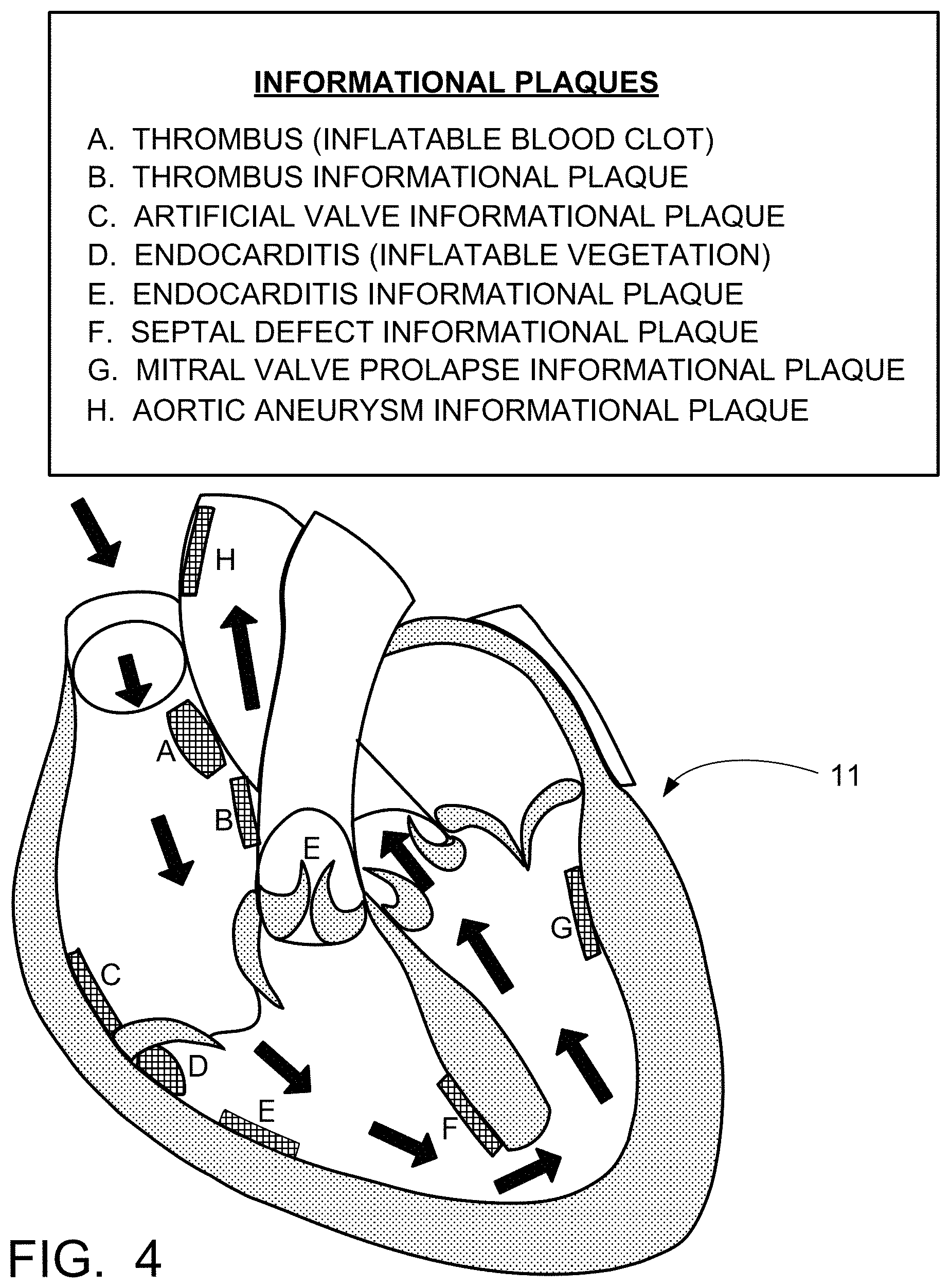 Patent US11776427 Figure 6 – Inflatable exhibit of a human heart and method