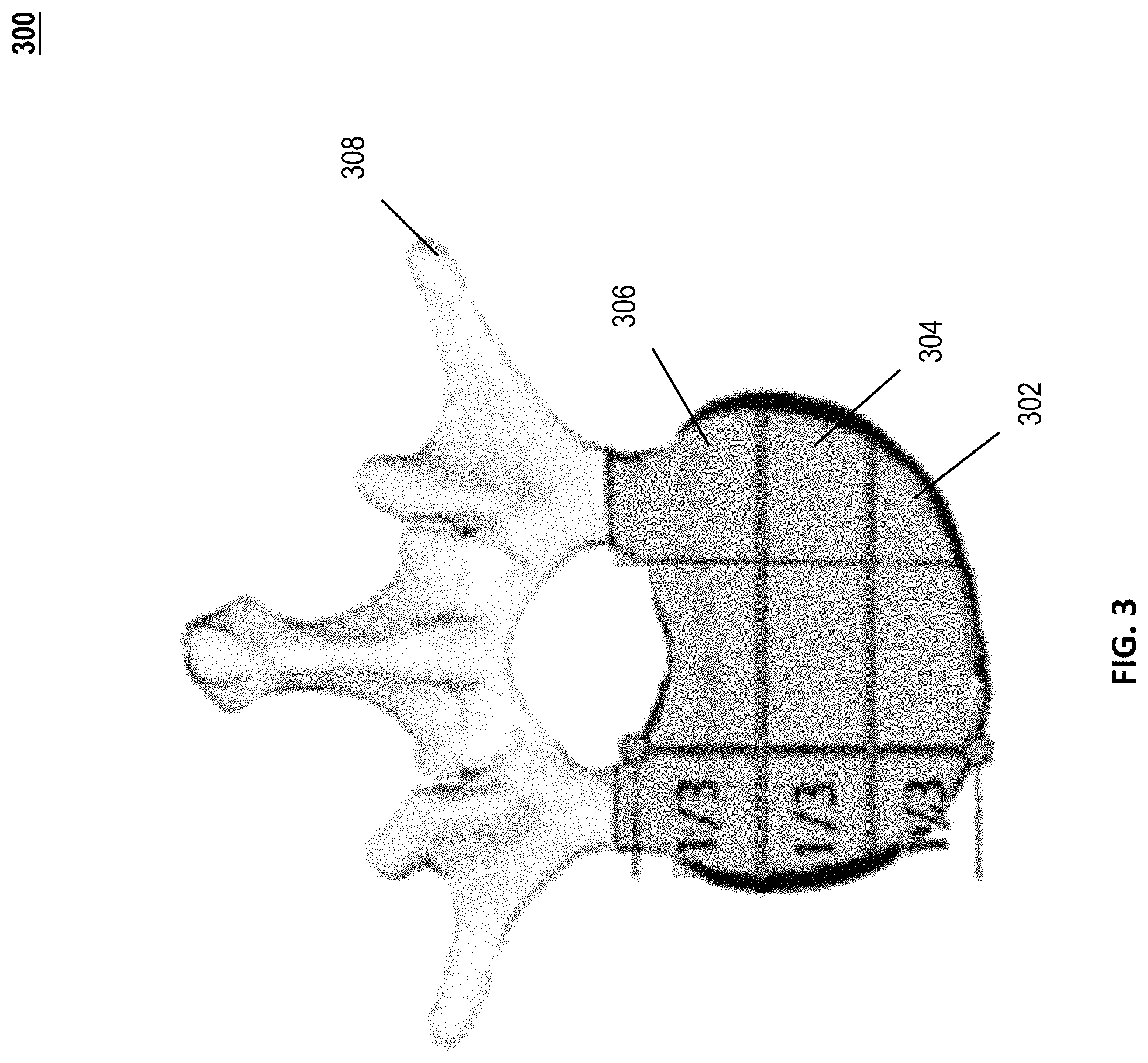 Patent US11776688 Figure 3 – Capturing user constructed map of bodily region of interest for remote telemedicine navigation