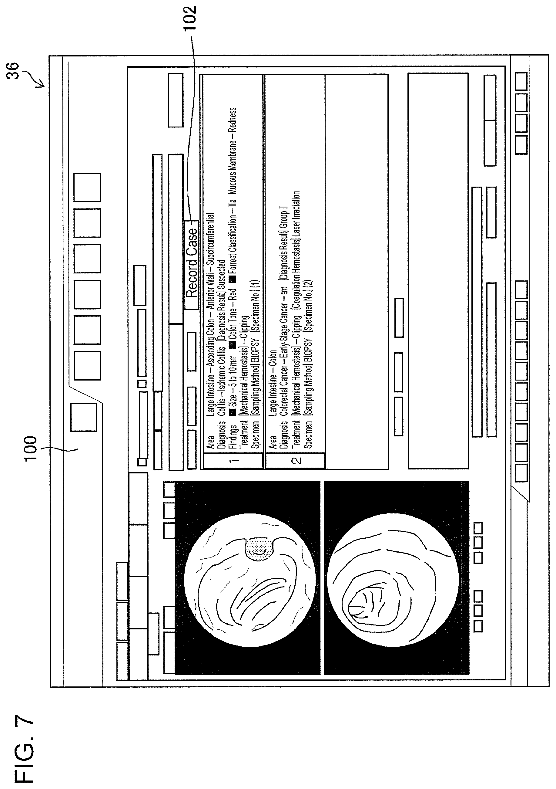 Patent US11776692 Figure 5 – Training data collection apparatus, training data collection method, program, training system, trained model, and endoscopic image processing apparatus