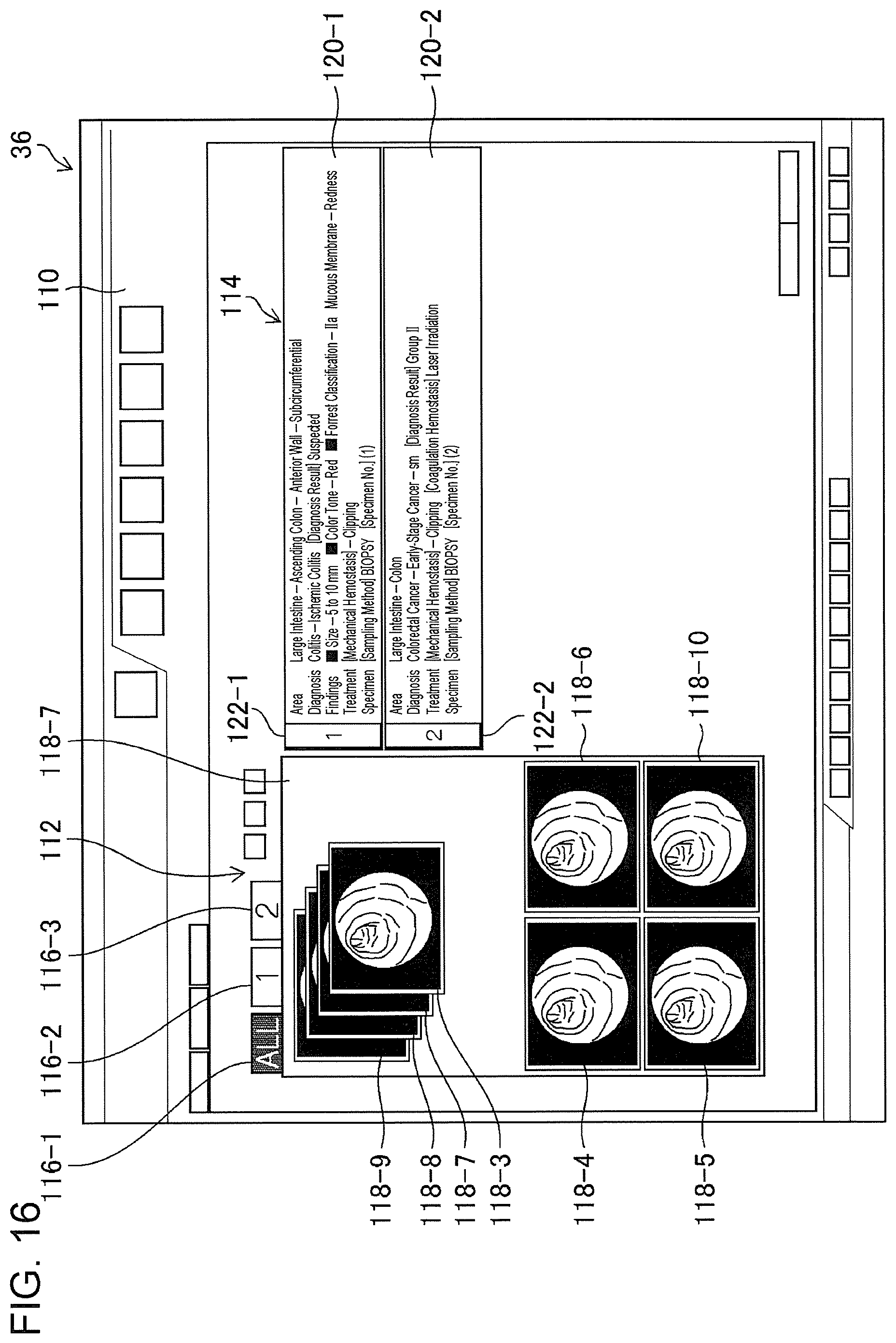 Patent US11776692 Figure 14 – Training data collection apparatus, training data collection method, program, training system, trained model, and endoscopic image processing apparatus