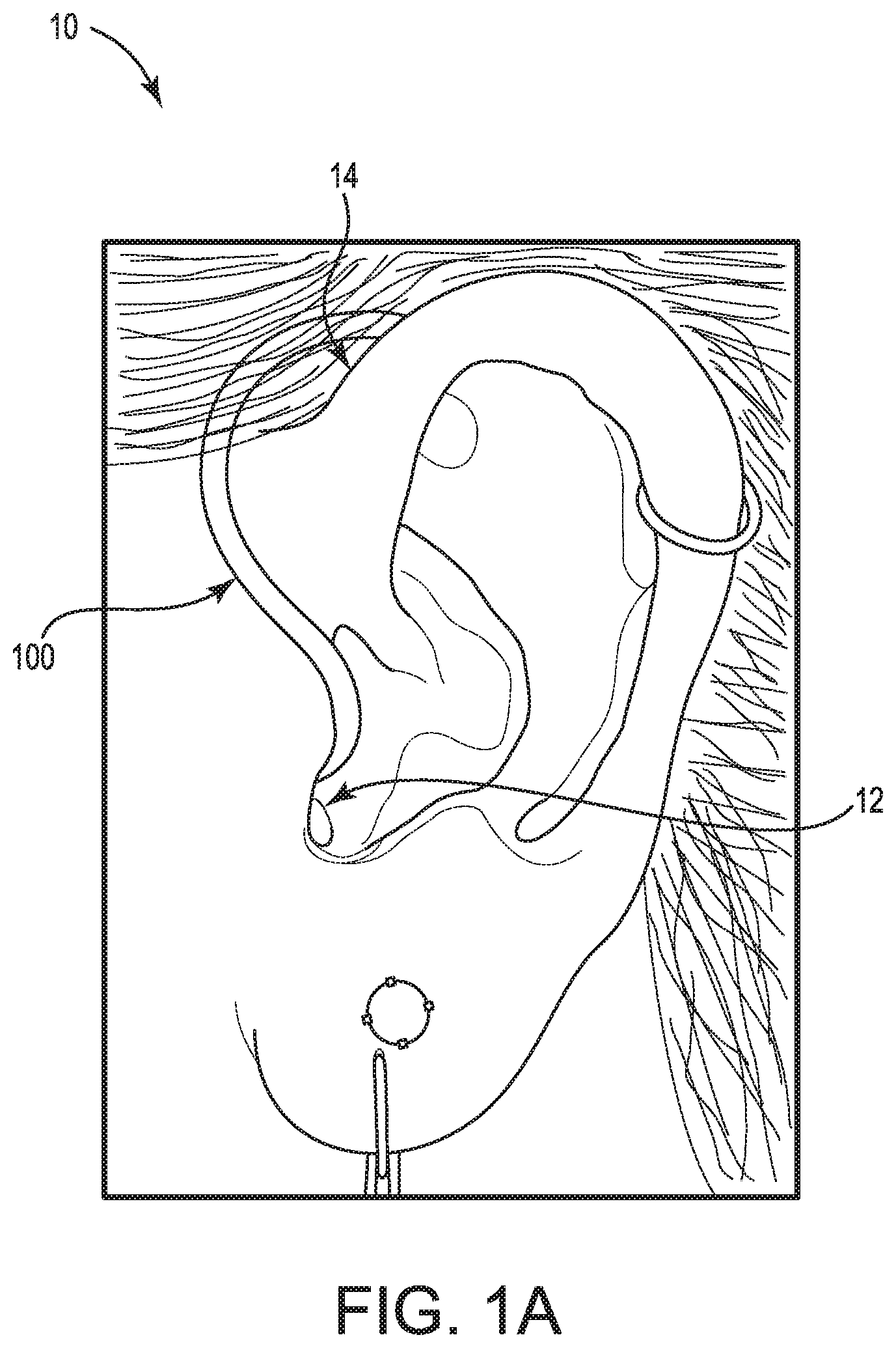 Patent US11778391 Figure 1 – Hearing device cable