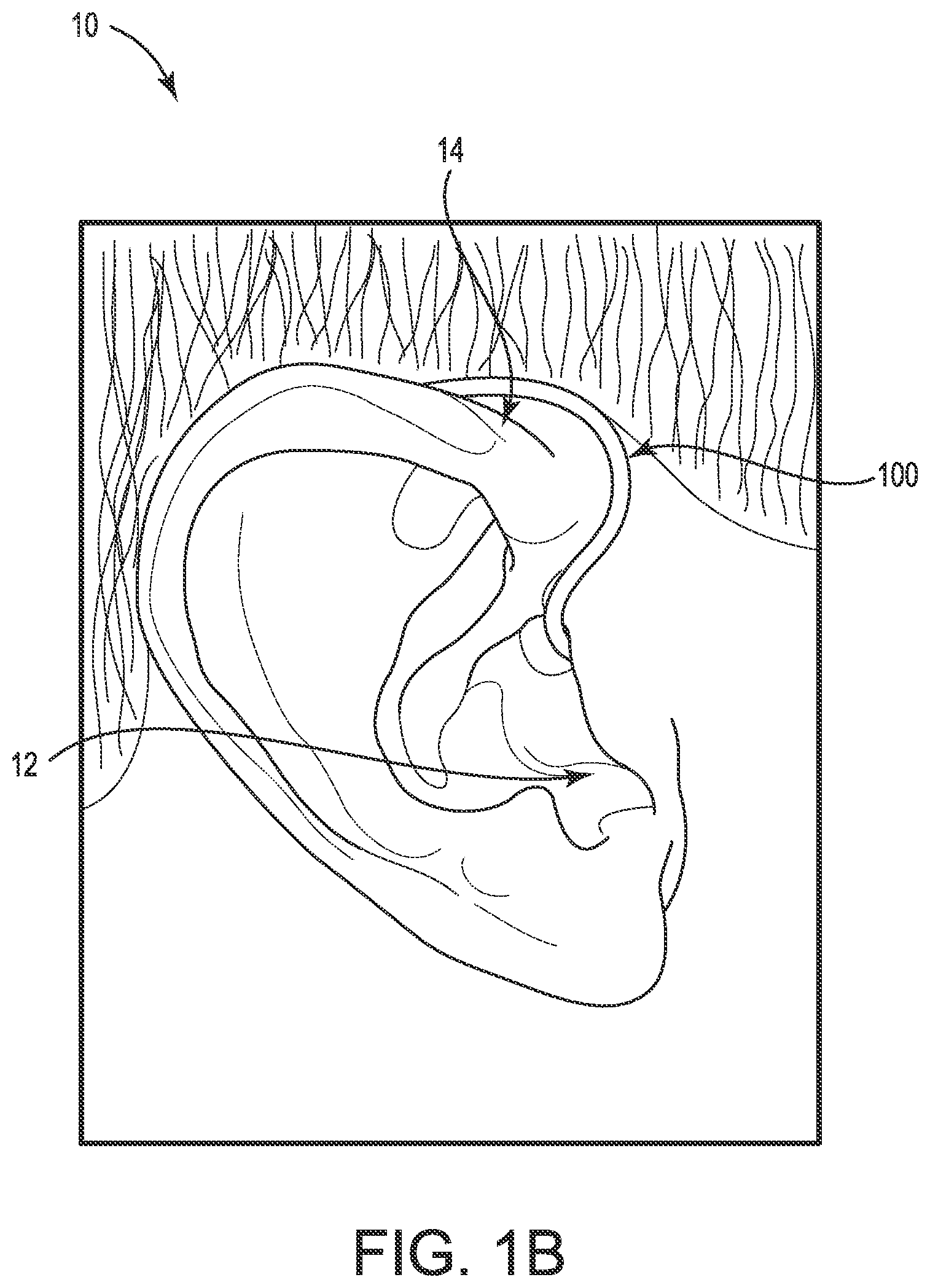 Patent US11778391 Figure 2 – Hearing device cable