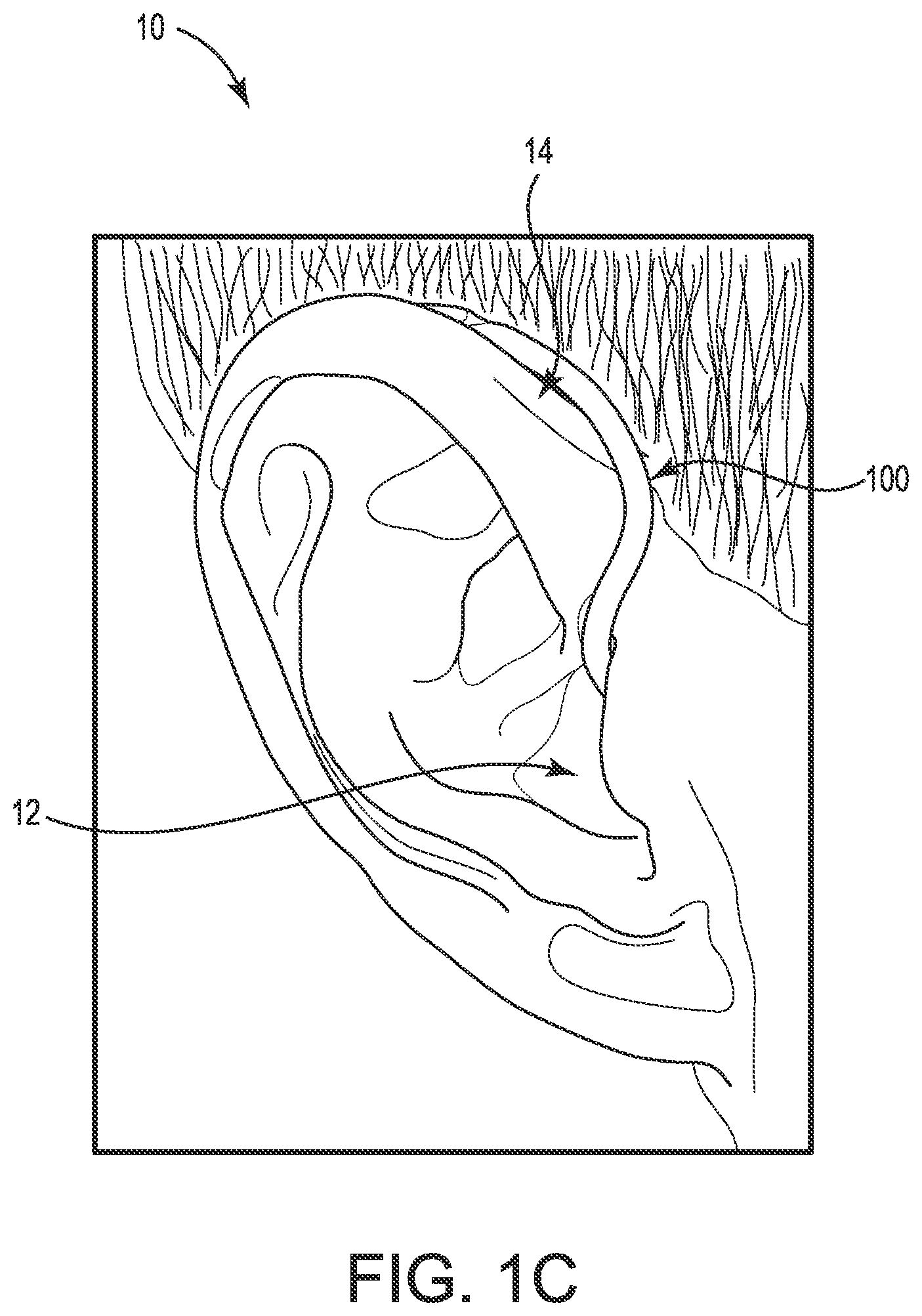 Patent US11778391 Figure 3 – Hearing device cable