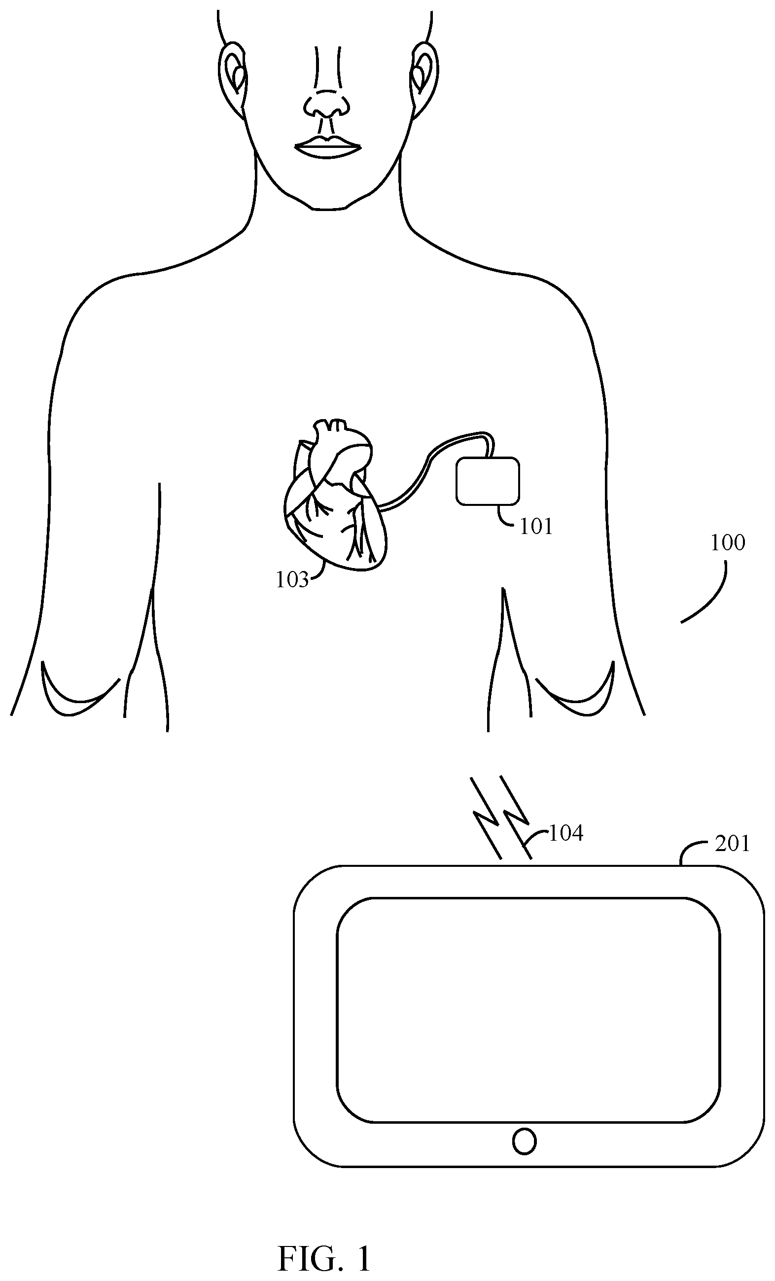 Patent US11778674 Figure 1 – Managing dynamic connection intervals for implantable and external devices