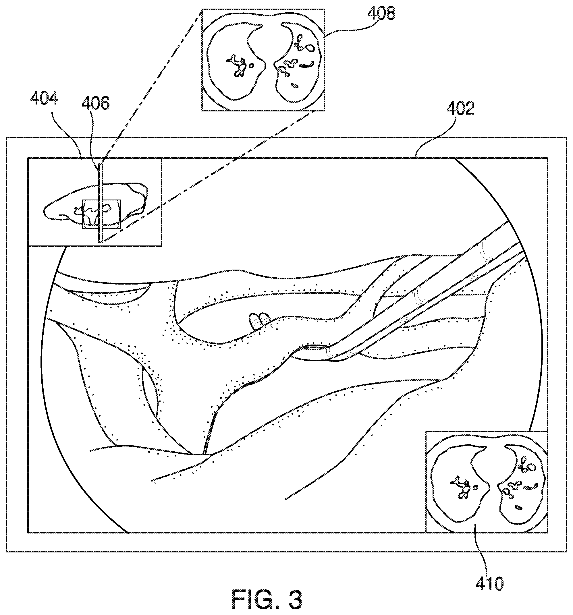 Patent US11779192 Figure 3 – Medical image viewer control from surgeon's camera