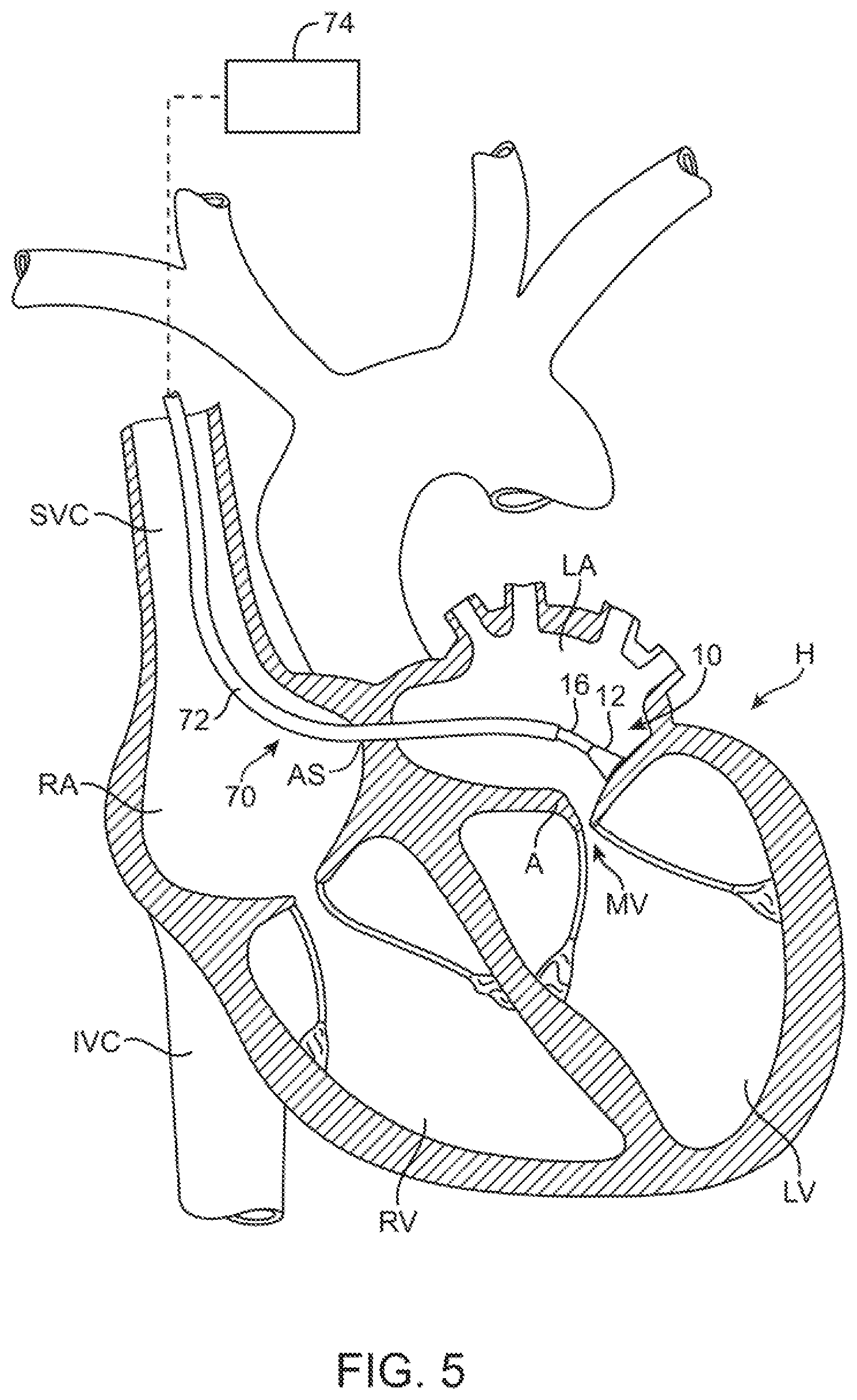 Patent US11779195 Figure 7 – Precision control systems for tissue visualization and manipulation assemblies