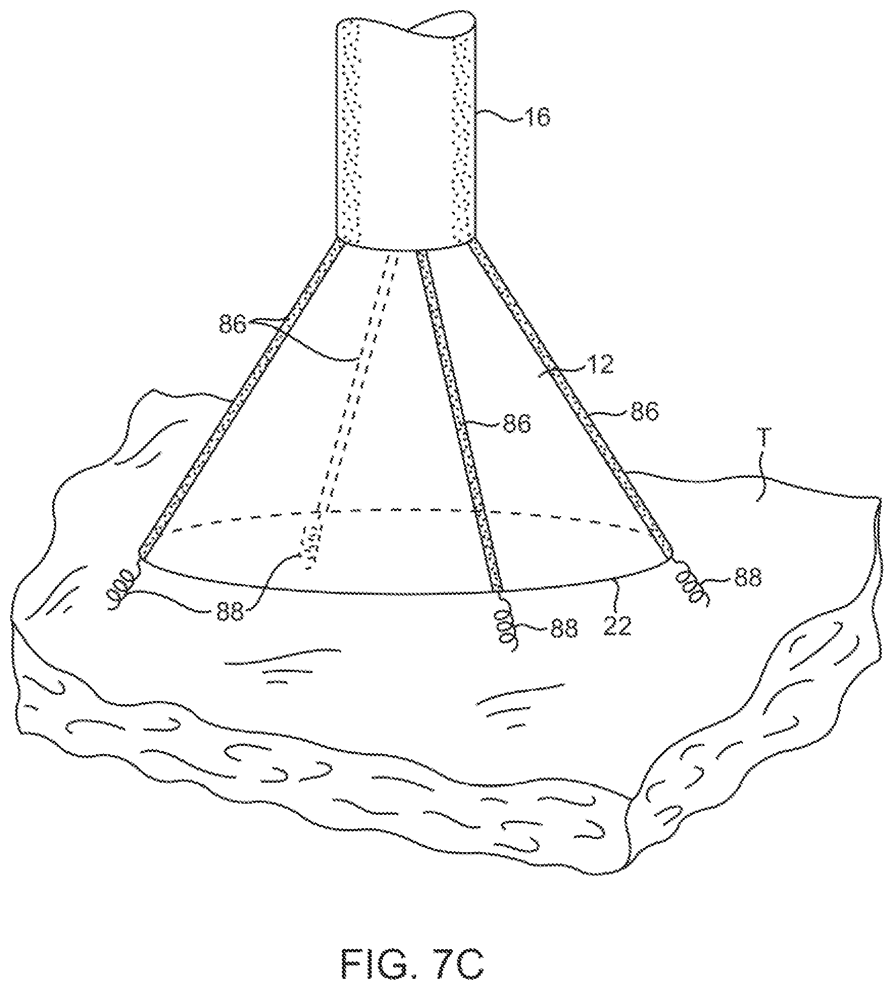 Patent US11779195 Figure 11 – Precision control systems for tissue visualization and manipulation assemblies