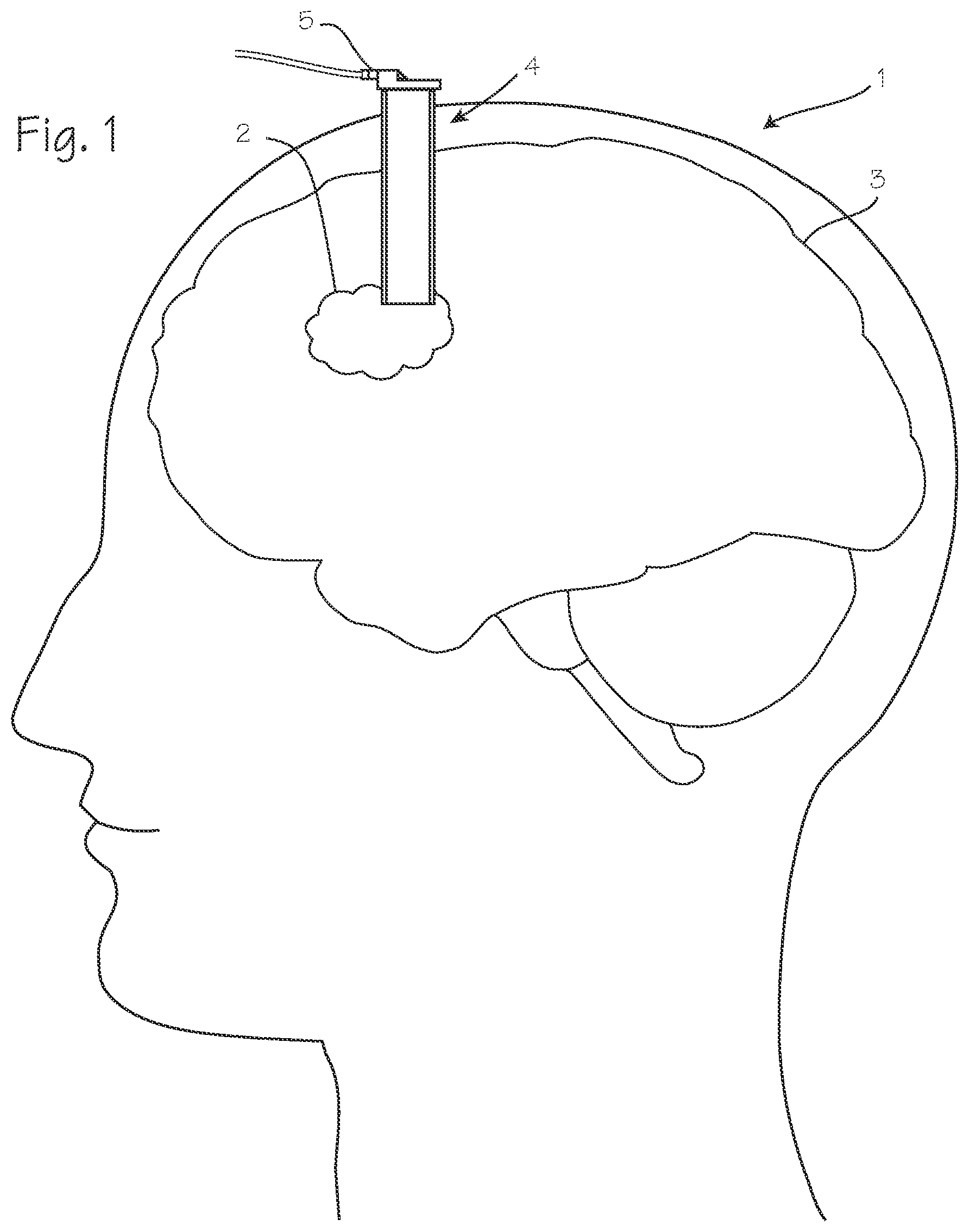 Patent US11779201 Figure 1 – Cannula with proximally mounted camera and transparent obturator
