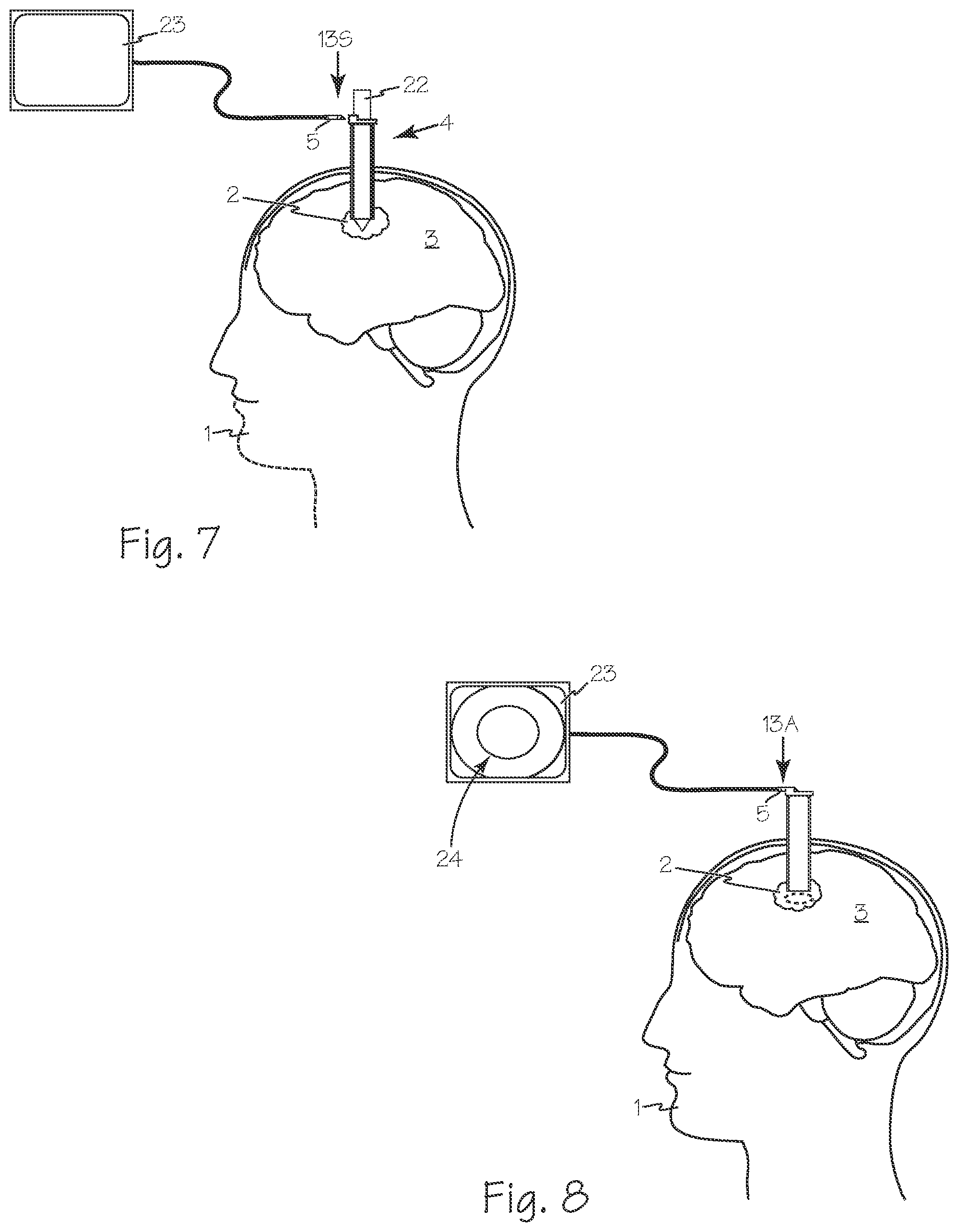 Patent US11779201 Figure 3 – Cannula with proximally mounted camera and transparent obturator