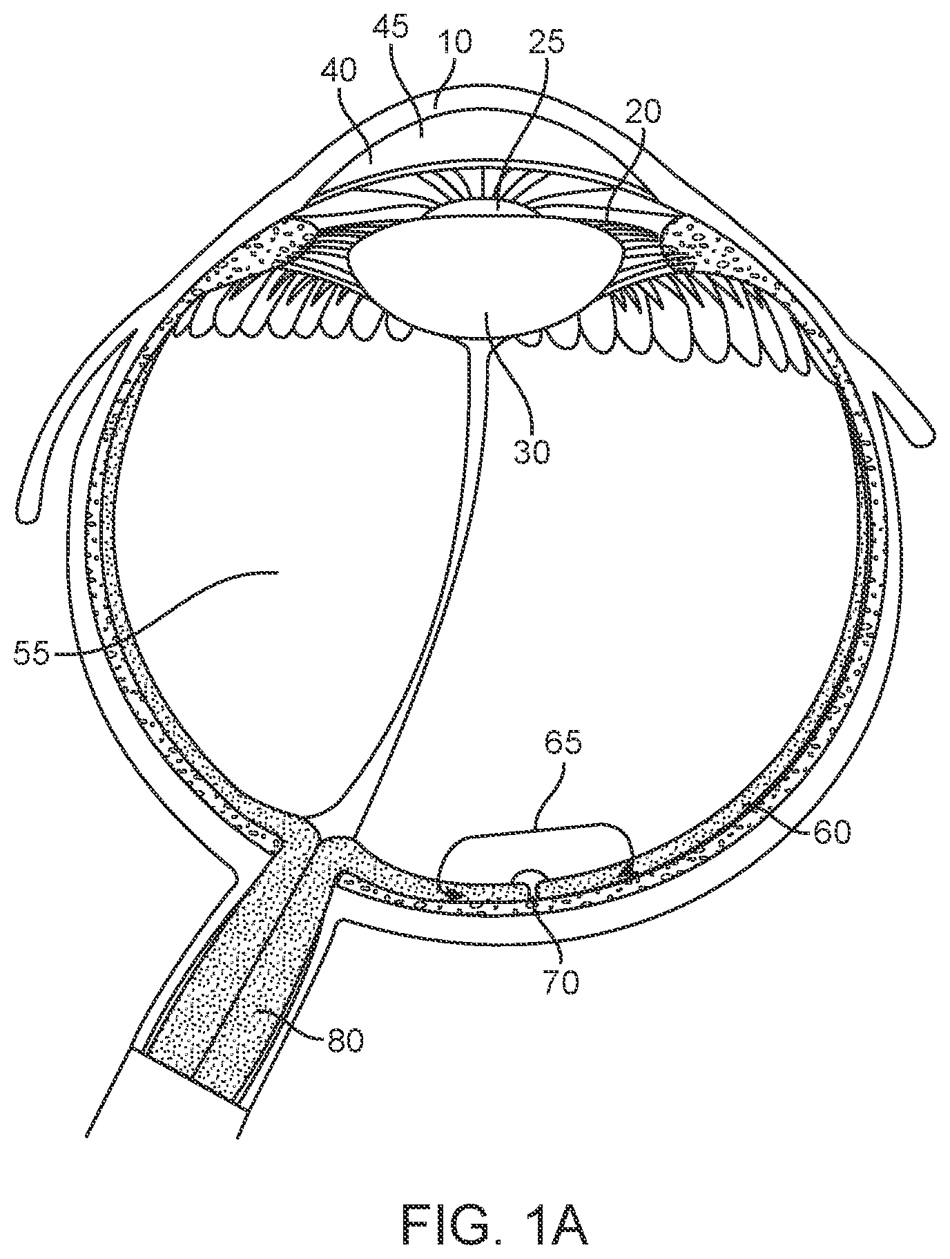 Patent US11779206 Figure 1 – Axial length measurement monitor